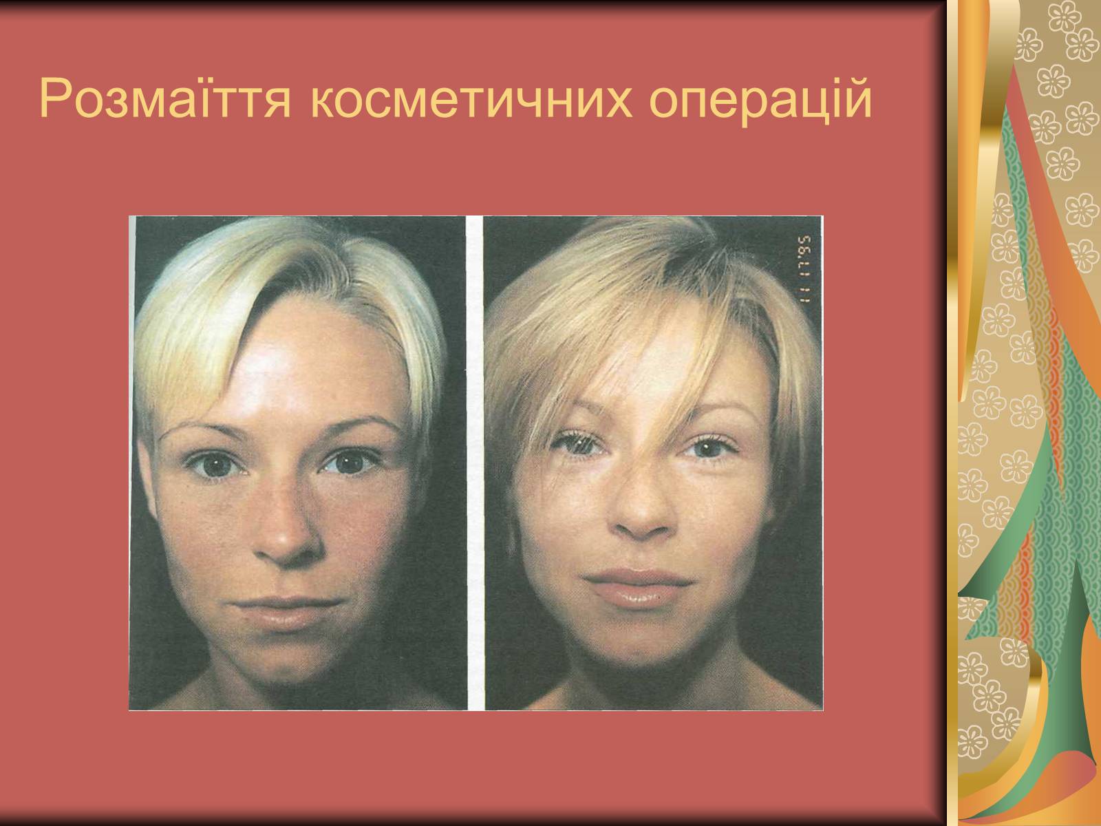 Презентація на тему «Моменти косметичної хірургії» - Слайд #41 Презентація на тему «Моменти косметичної хірургії» - Слайд #41