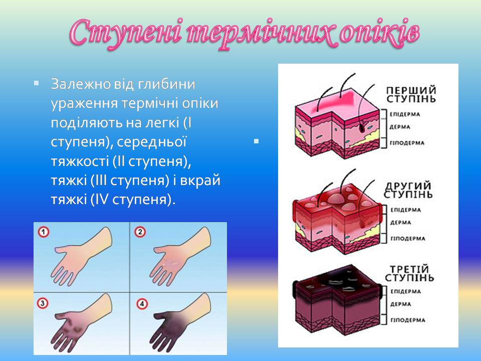 Презентація на тему «Опіки» (варіант 13) - Слайд #4 Презентація на тему «Опіки» (варіант 13) - Слайд #4