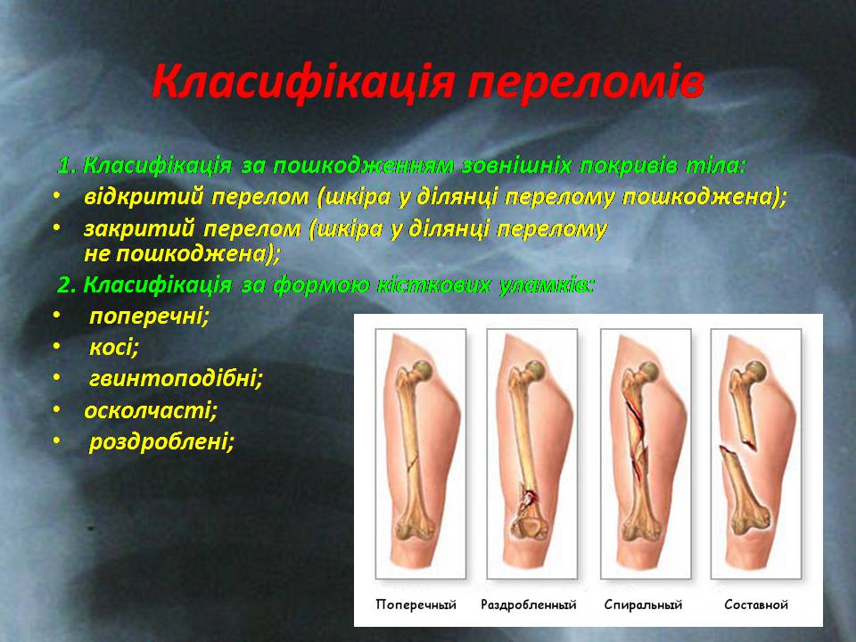 Презентація на тему «Правила надання першої допомоги ?при переломах» - Слайд #5 Презентація на тему «Правила надання першої допомоги ?при переломах» - Слайд #5