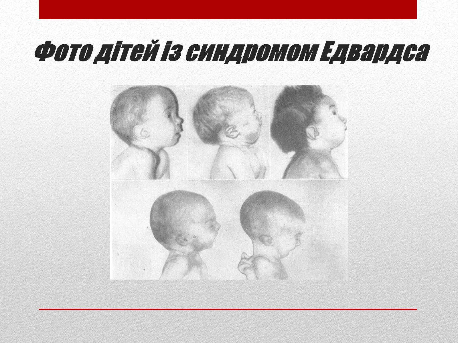 Презентація на тему «Спадкові хвороби людини» - Слайд #11 Презентація на тему «Спадкові хвороби людини» - Слайд #11