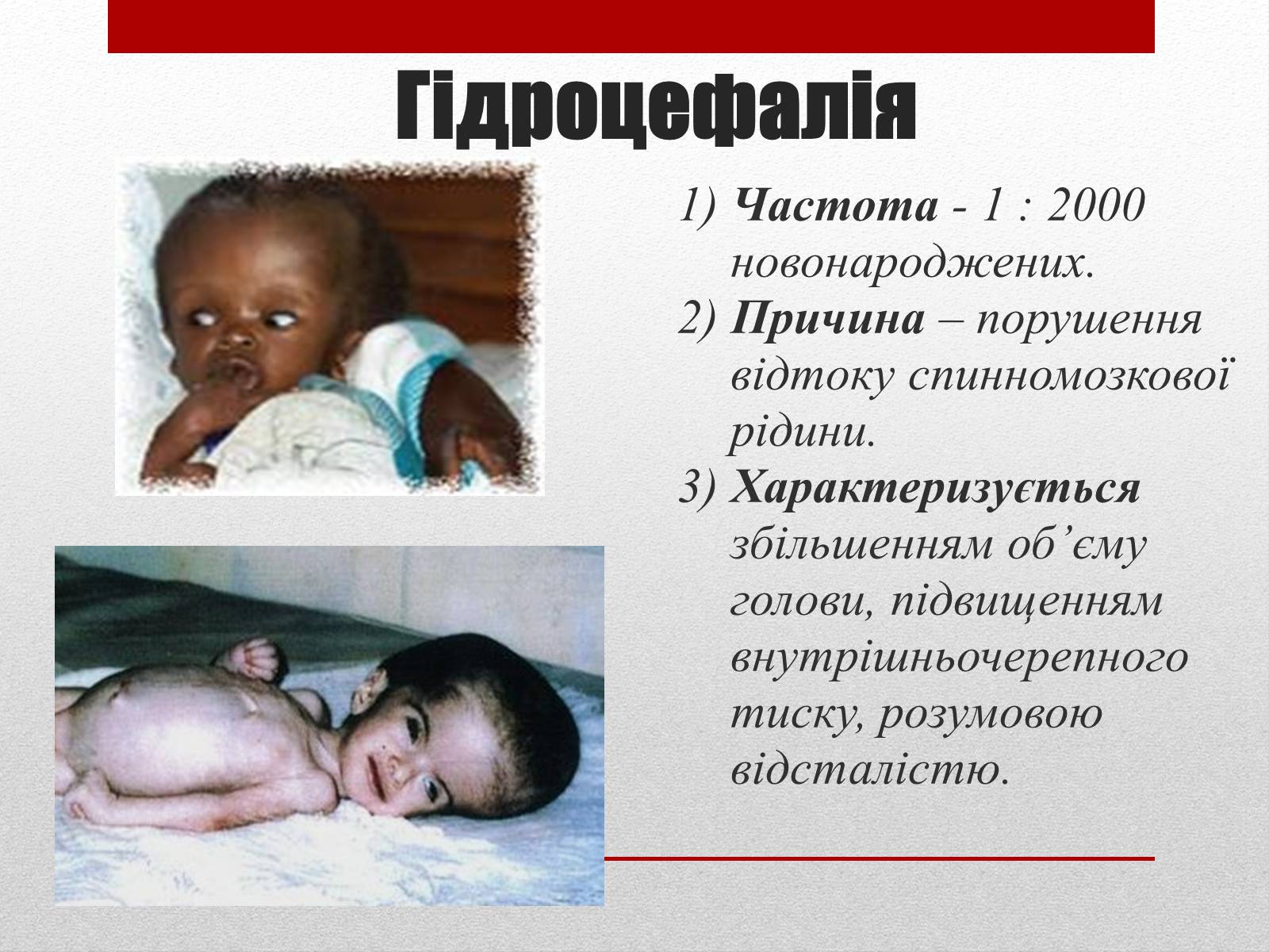 Презентація на тему «Спадкові хвороби людини» - Слайд #16 Презентація на тему «Спадкові хвороби людини» - Слайд #16