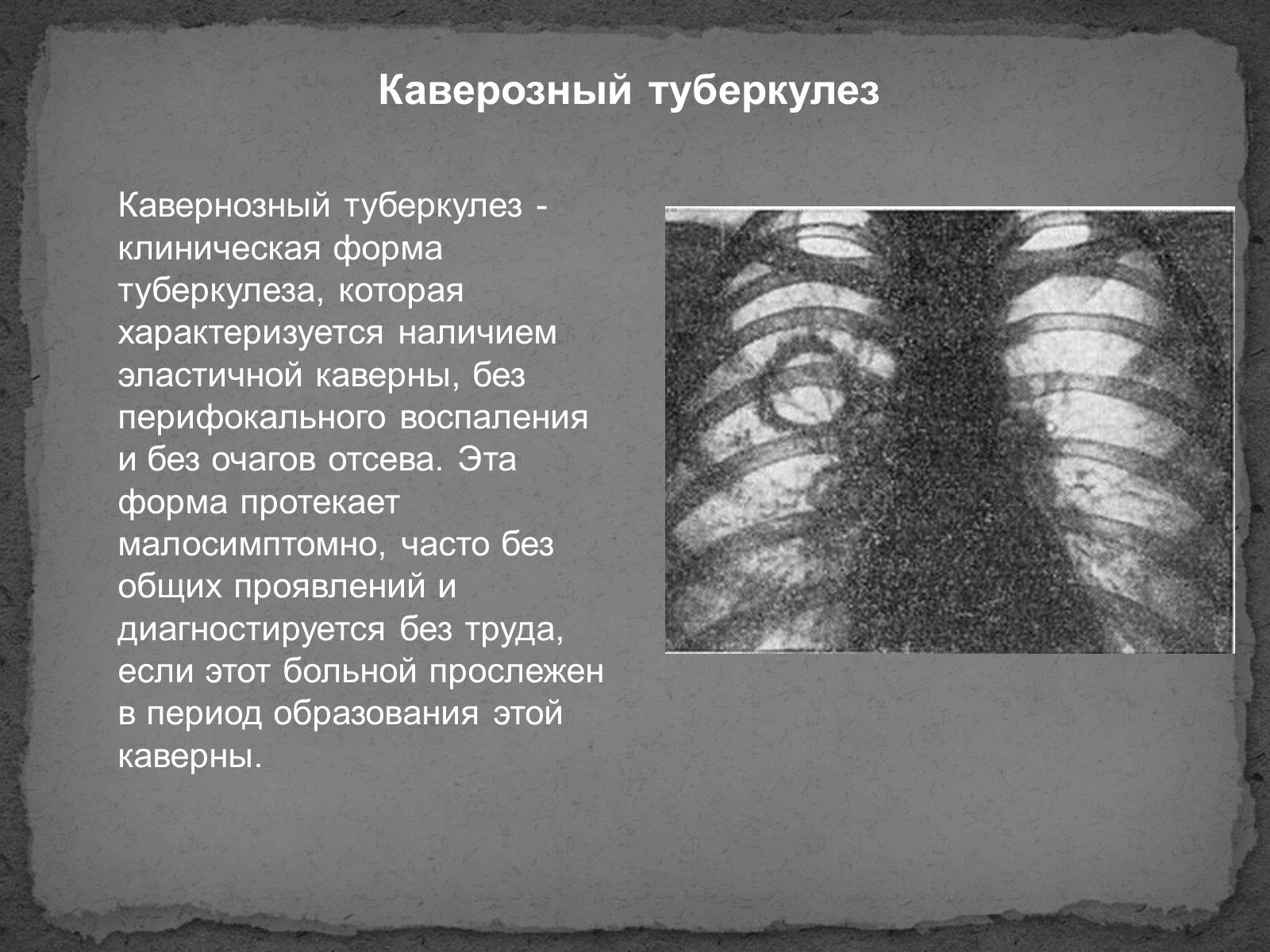 Презентація на тему «Туберкулез» (варіант 1) - Слайд #10 Презентація на тему «Туберкулез» (варіант 1) - Слайд #10