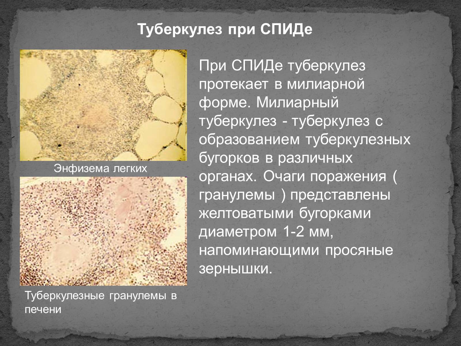 Презентація на тему «Туберкулез» (варіант 1) - Слайд #11 Презентація на тему «Туберкулез» (варіант 1) - Слайд #11