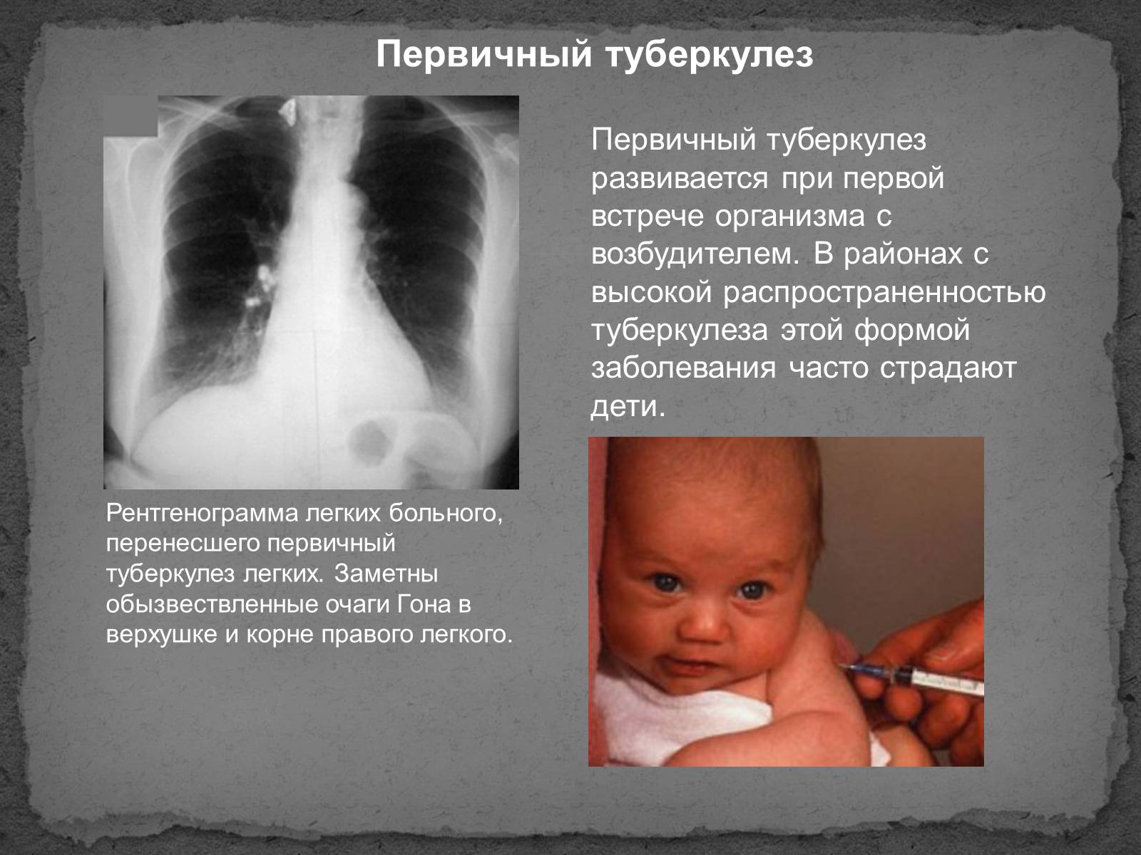 Презентація на тему «Туберкулез» (варіант 1) - Слайд #5 Презентація на тему «Туберкулез» (варіант 1) - Слайд #5