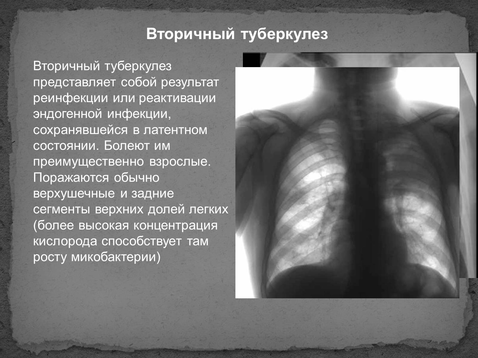 Презентація на тему «Туберкулез» (варіант 1) - Слайд #6 Презентація на тему «Туберкулез» (варіант 1) - Слайд #6