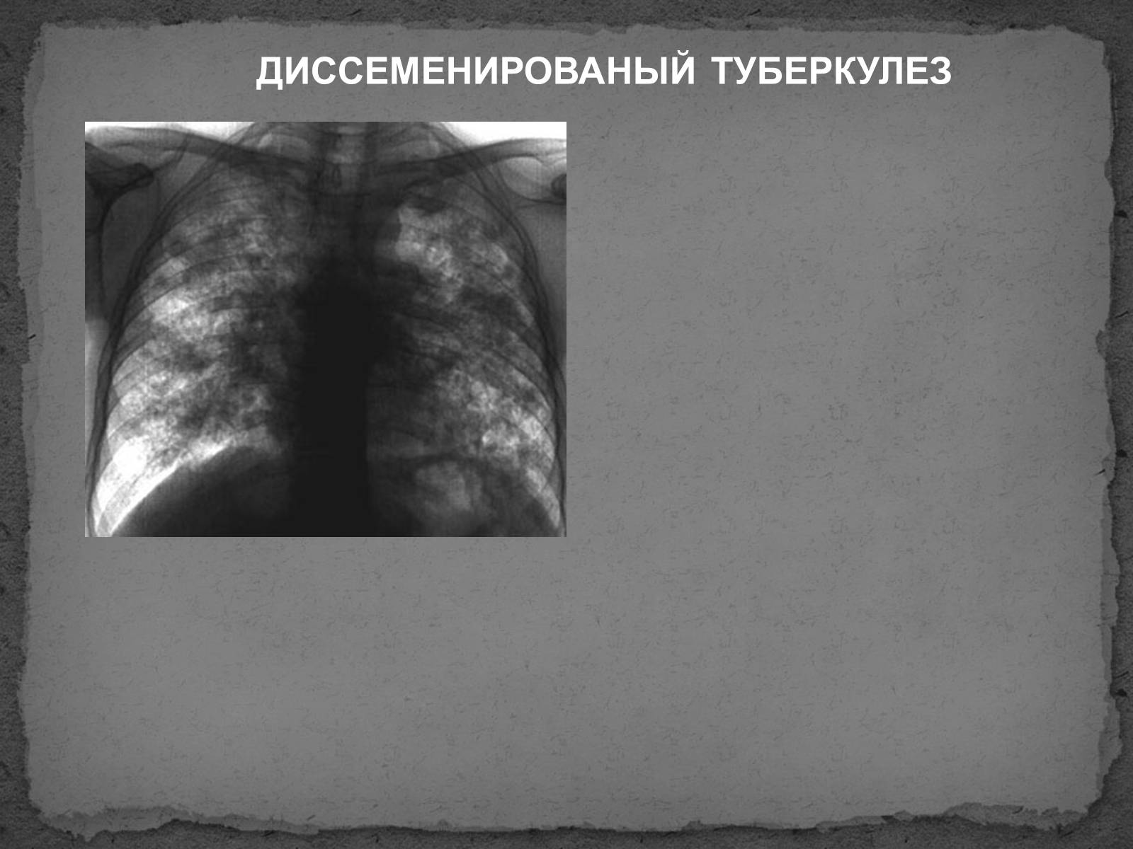 Презентація на тему «Туберкулез» (варіант 1) - Слайд #7 Презентація на тему «Туберкулез» (варіант 1) - Слайд #7