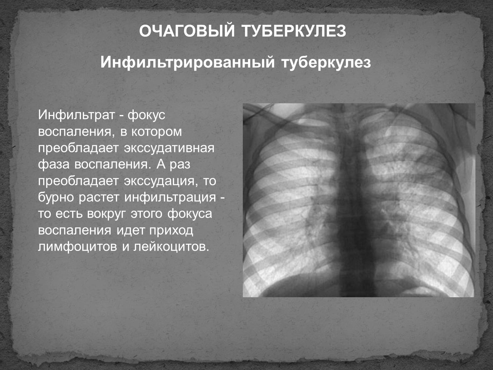 Презентація на тему «Туберкулез» (варіант 1) - Слайд #8 Презентація на тему «Туберкулез» (варіант 1) - Слайд #8