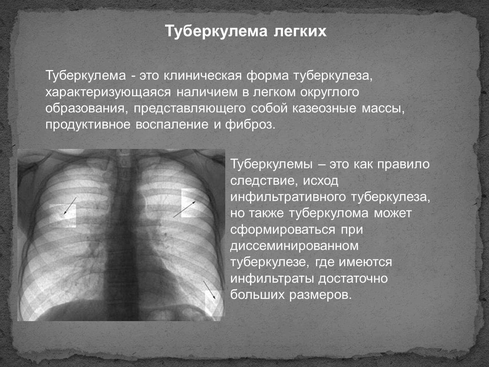 Презентація на тему «Туберкулез» (варіант 1) - Слайд #9 Презентація на тему «Туберкулез» (варіант 1) - Слайд #9