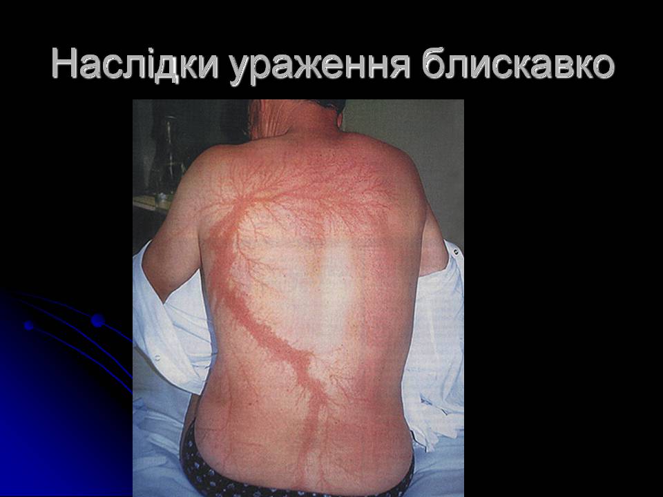 Презентація на тему «Ураження блискавкою» (варіант 2) - Слайд #7 Презентація на тему «Ураження блискавкою» (варіант 2) - Слайд #7