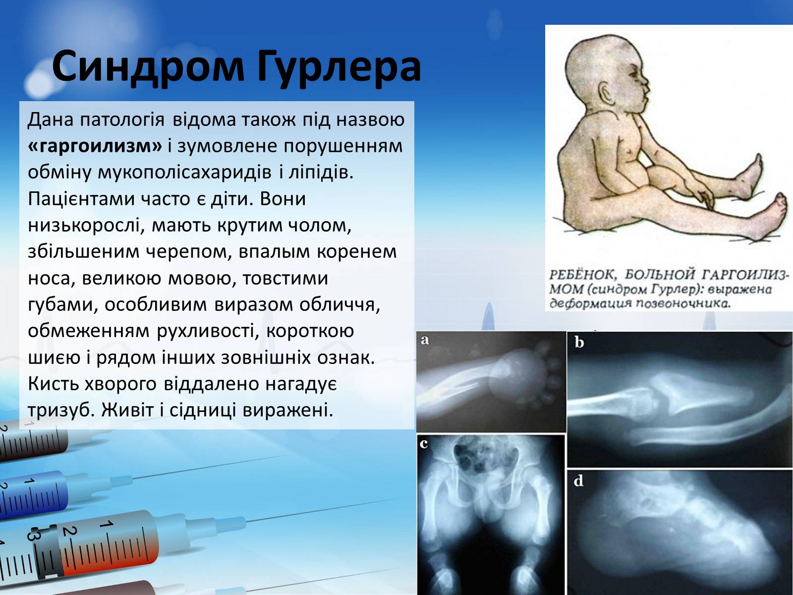 Презентація на тему «Спадкові хвороби» (варіант 2) - Слайд #11 Презентація на тему «Спадкові хвороби» (варіант 2) - Слайд #11