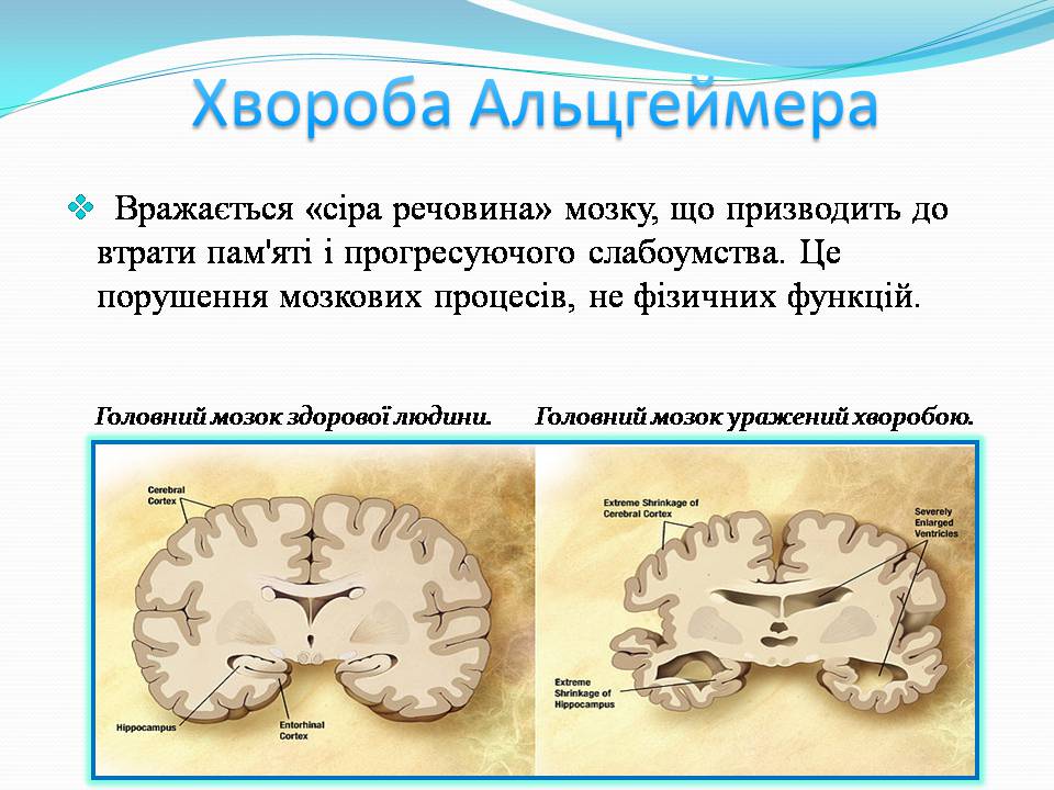 Презентація на тему «Генетичні захворювання» (варіант 2) - Слайд #12 Презентація на тему «Генетичні захворювання» (варіант 2) - Слайд #12