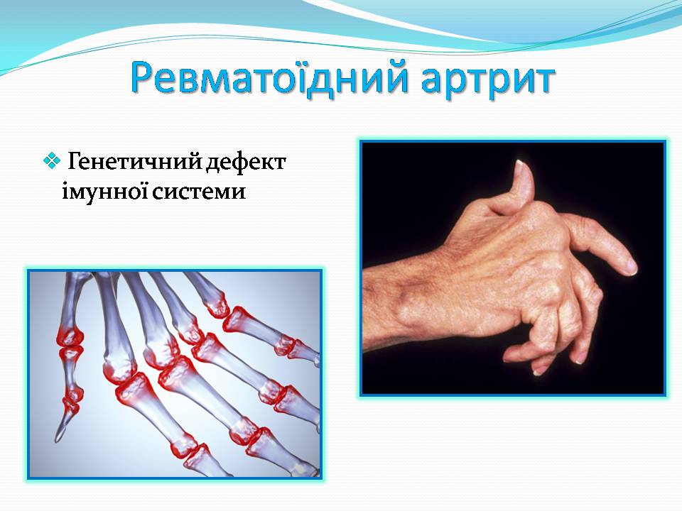 Презентація на тему «Генетичні захворювання» (варіант 2) - Слайд #14 Презентація на тему «Генетичні захворювання» (варіант 2) - Слайд #14