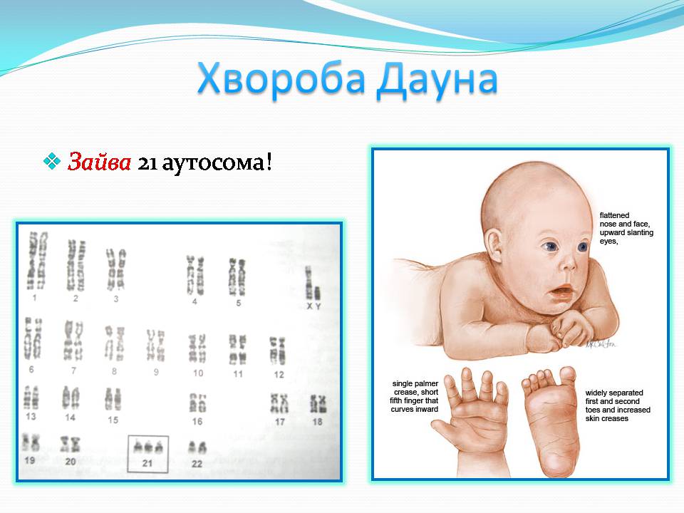Презентація на тему «Генетичні захворювання» (варіант 2) - Слайд #16 Презентація на тему «Генетичні захворювання» (варіант 2) - Слайд #16