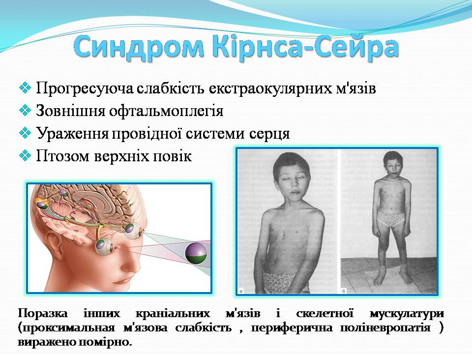 Презентація на тему «Генетичні захворювання» (варіант 2) - Слайд #21 Презентація на тему «Генетичні захворювання» (варіант 2) - Слайд #21