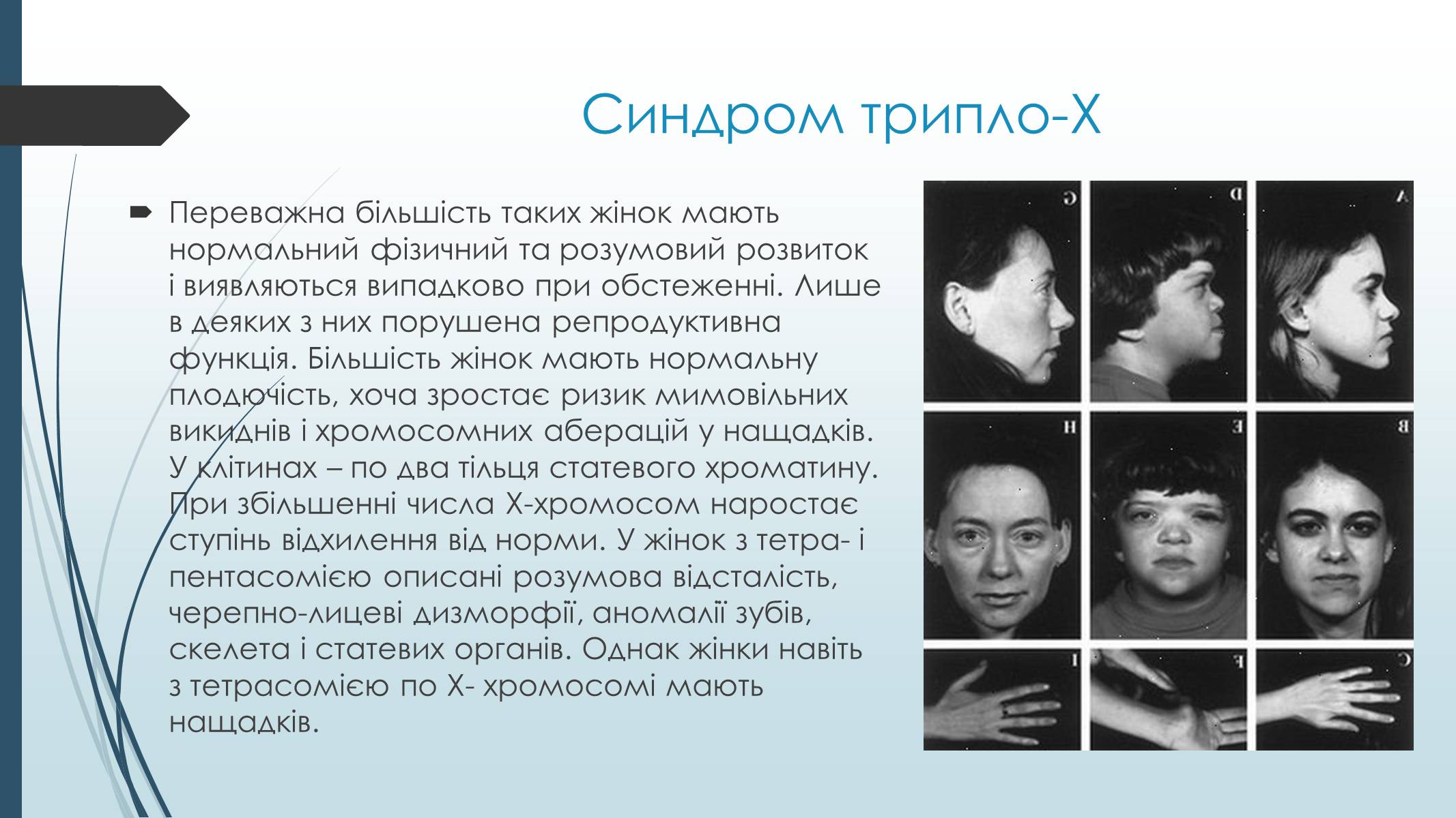 Презентація на тему «Хромосомні хвороби людини» - Слайд #7 Презентація на тему «Хромосомні хвороби людини» - Слайд #7