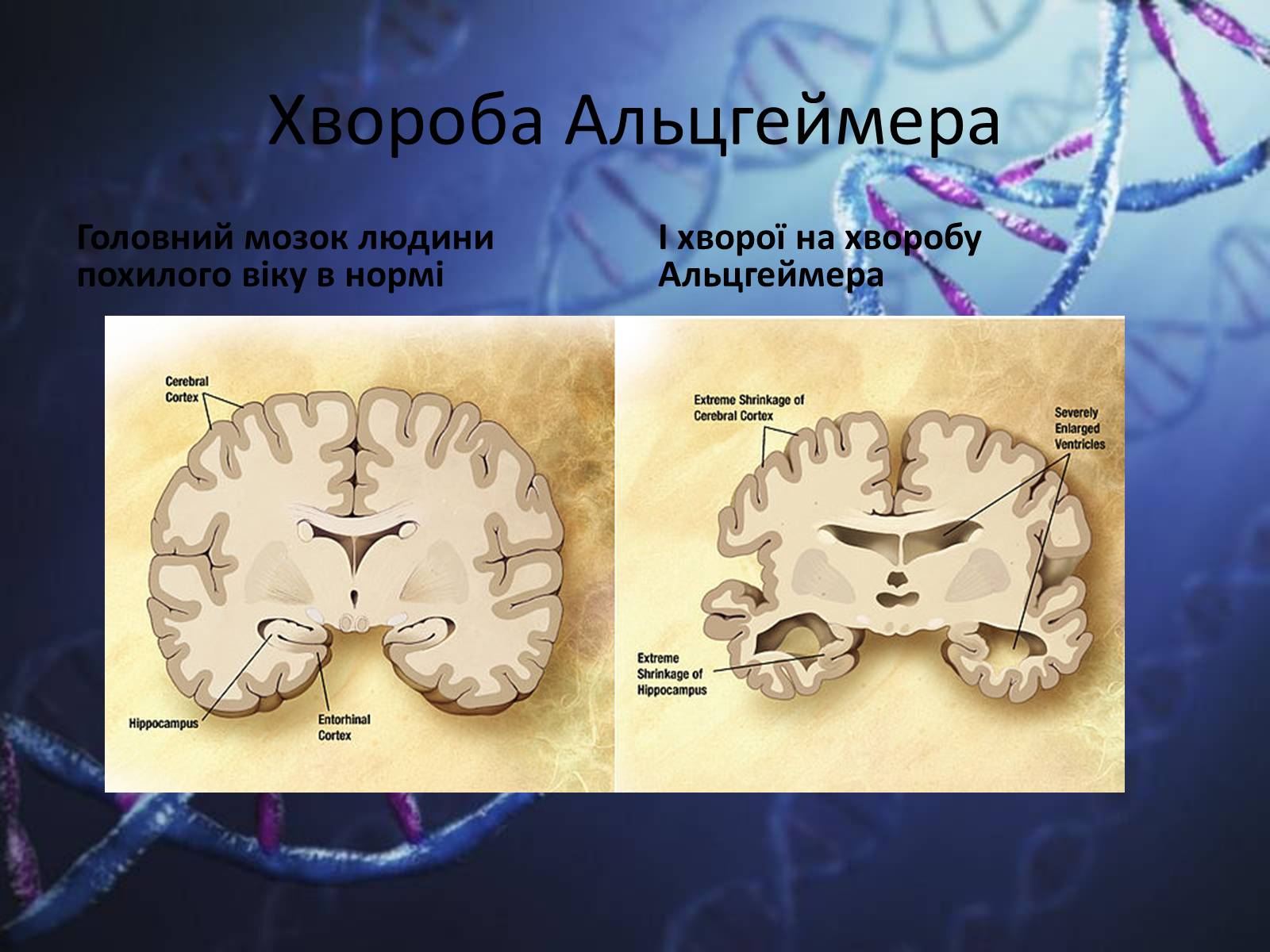 Презентація на тему «Генетичні захворювання людини» - Слайд #10 Презентація на тему «Генетичні захворювання людини» - Слайд #10