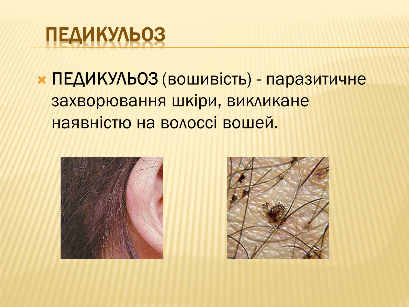 Презентація на тему «Хвороби шкіри» - Слайд #11 Презентація на тему «Хвороби шкіри» - Слайд #11