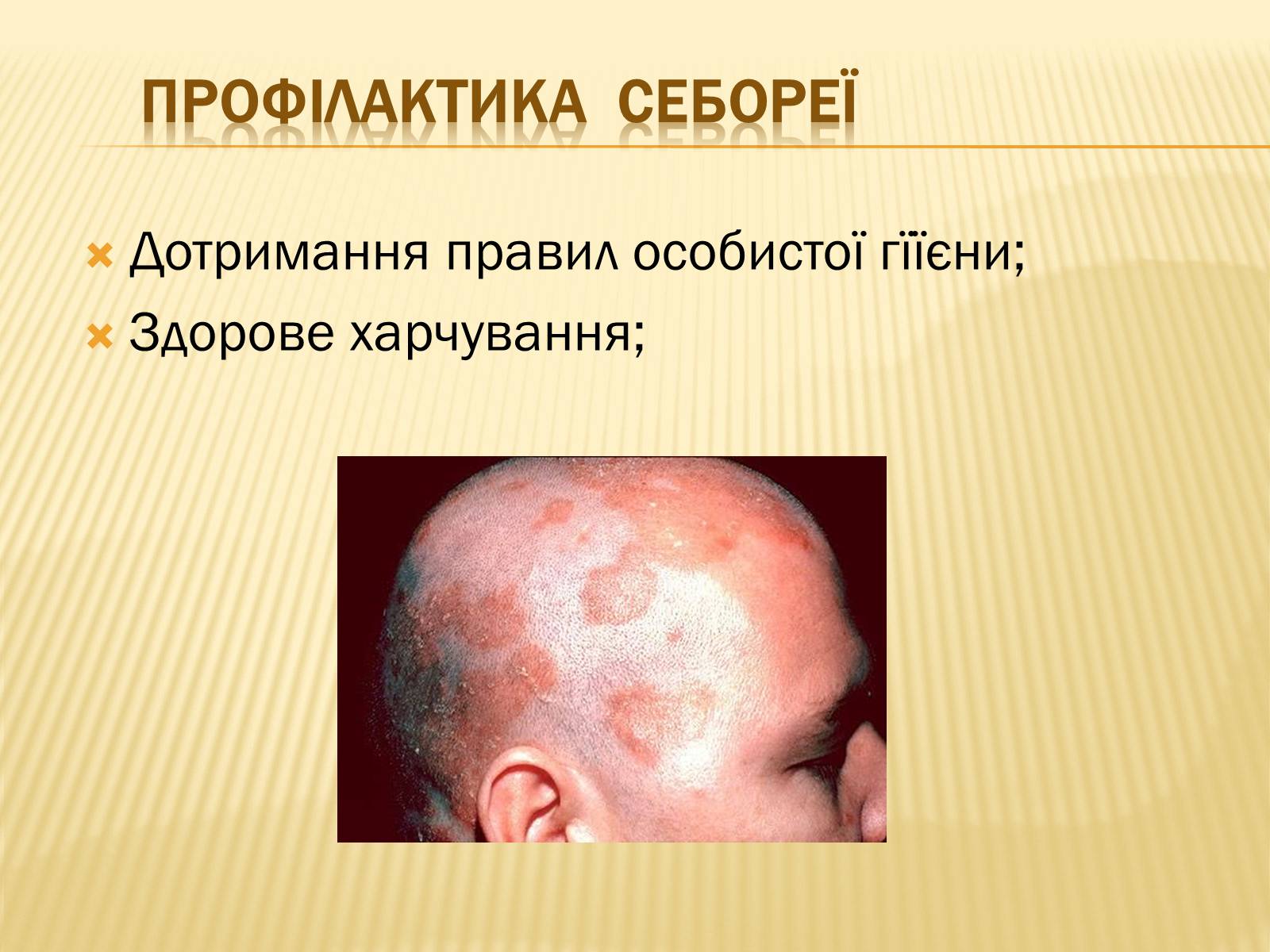 Презентація на тему «Хвороби шкіри» - Слайд #23 Презентація на тему «Хвороби шкіри» - Слайд #23