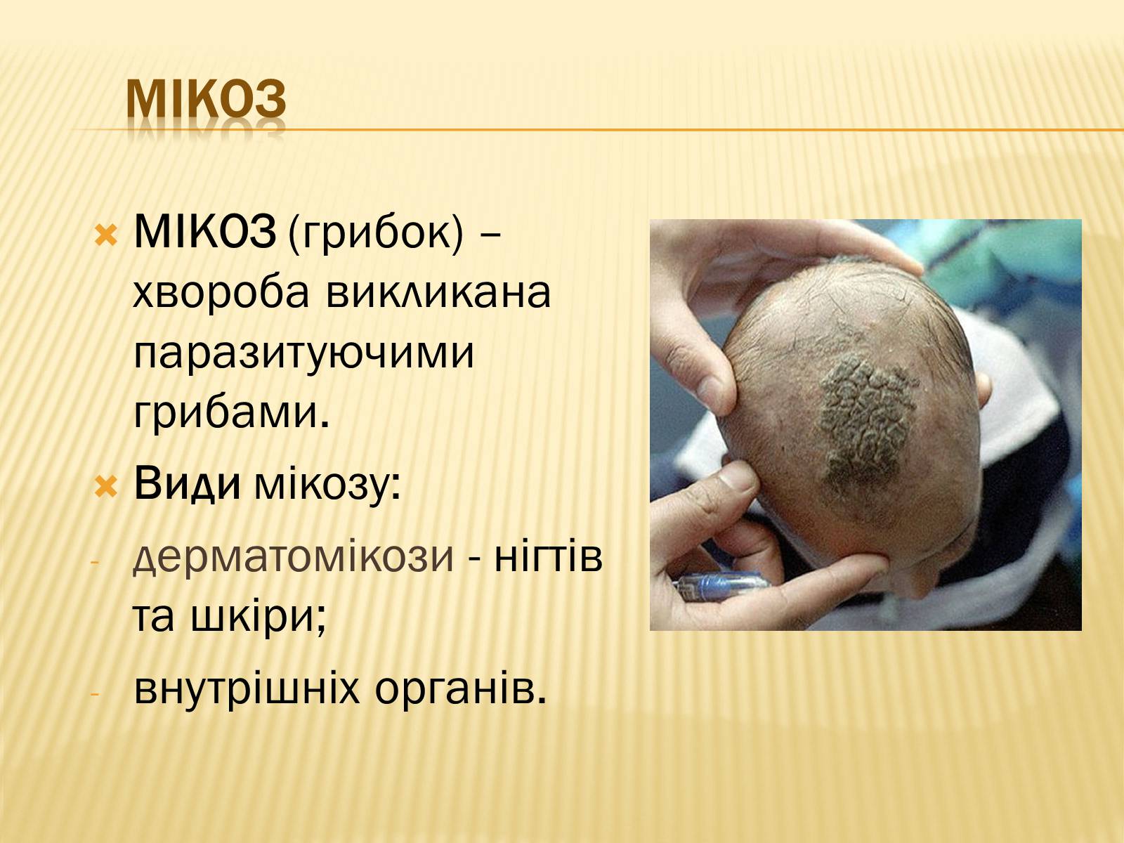 Презентація на тему «Хвороби шкіри» - Слайд #24 Презентація на тему «Хвороби шкіри» - Слайд #24