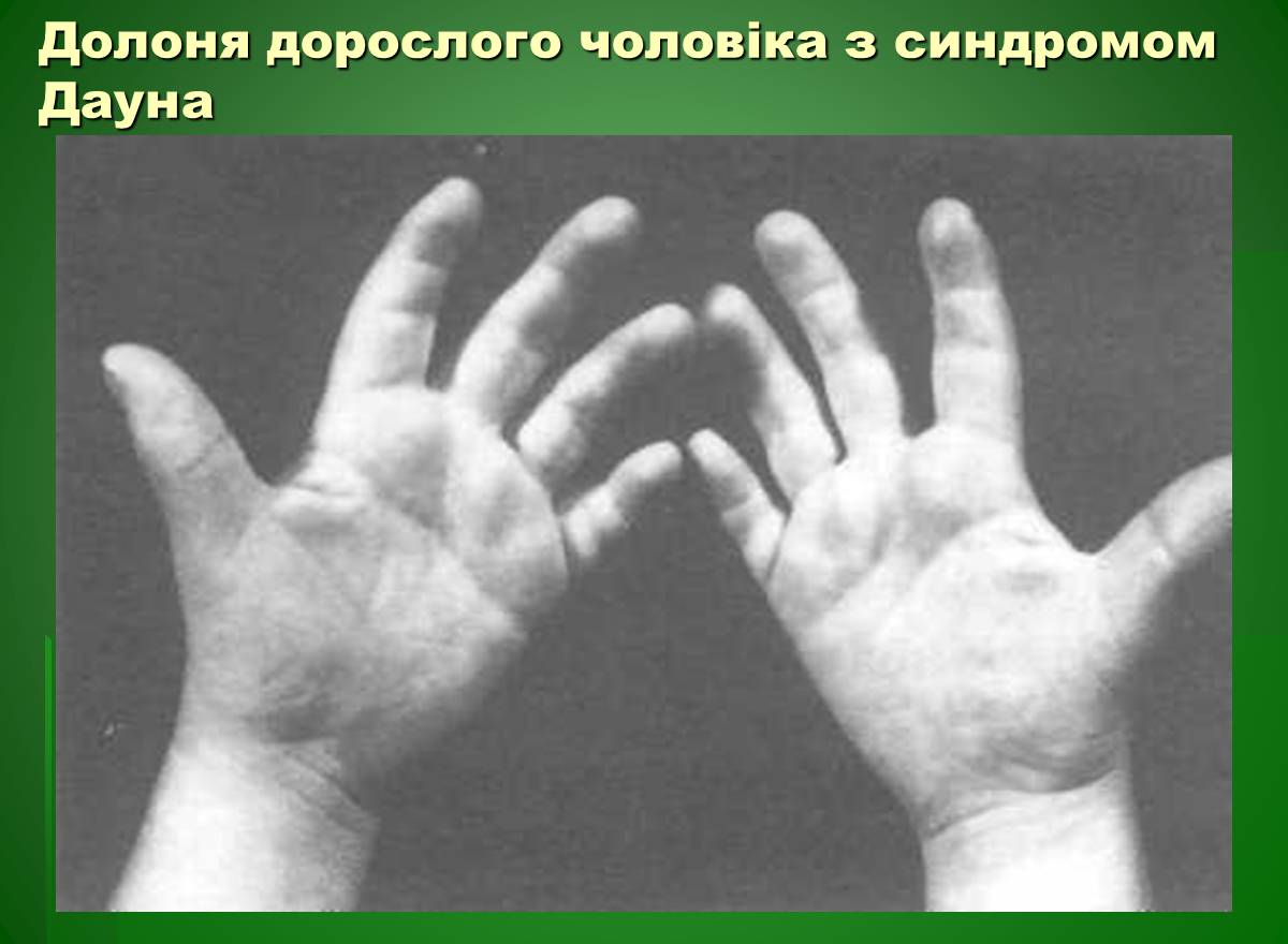 Презентація на тему «Основи медичної генетики» - Слайд #17 Презентація на тему «Основи медичної генетики» - Слайд #17