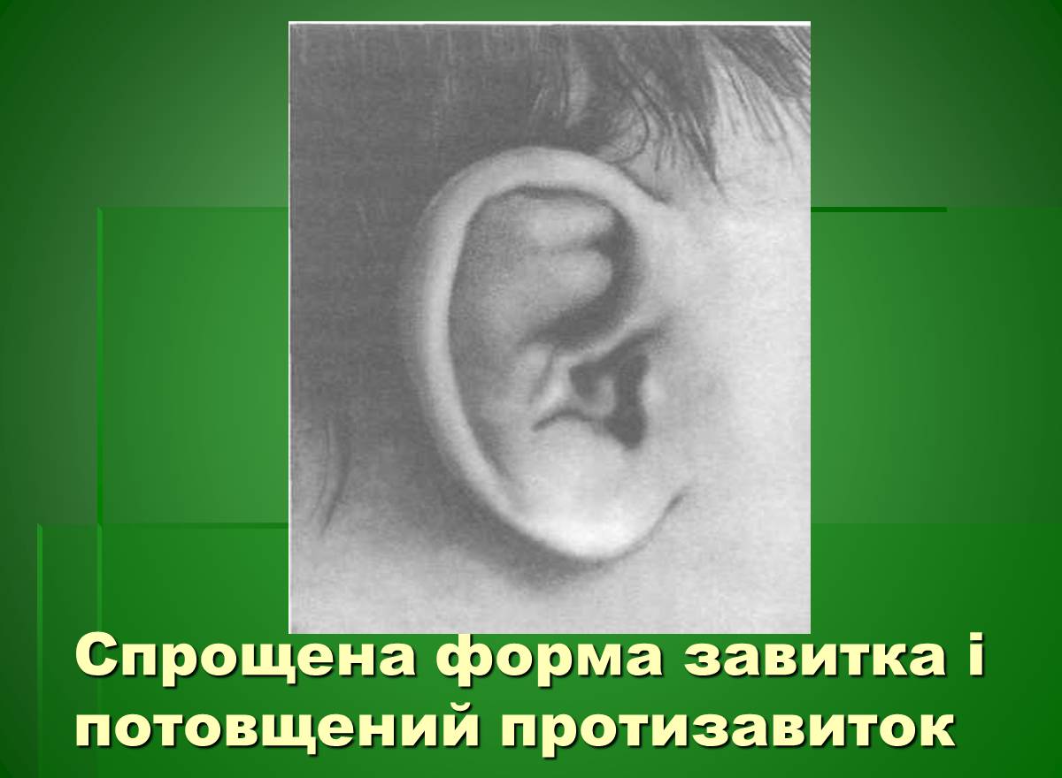 Презентація на тему «Основи медичної генетики» - Слайд #21 Презентація на тему «Основи медичної генетики» - Слайд #21