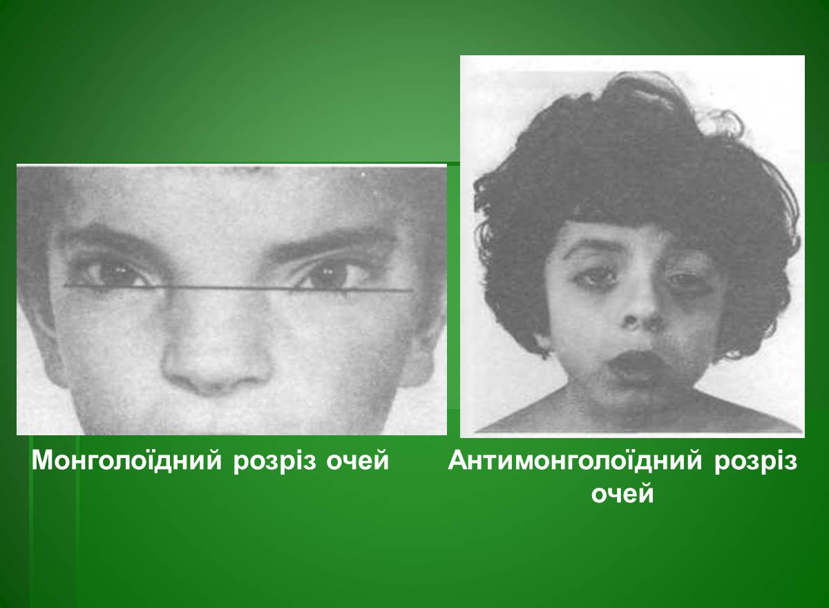 Презентація на тему «Основи медичної генетики» - Слайд #22 Презентація на тему «Основи медичної генетики» - Слайд #22