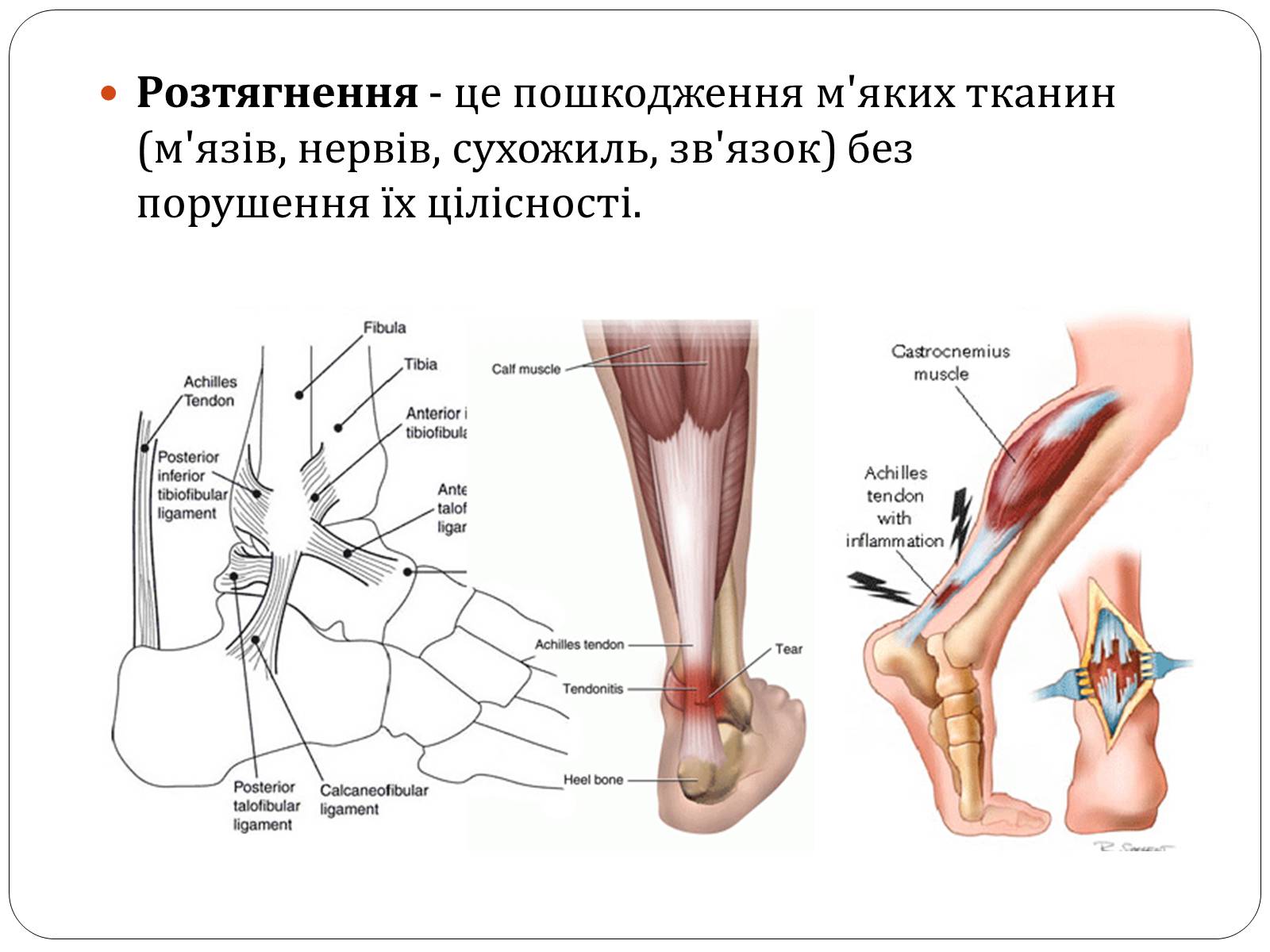 Презентація на тему «Вивихи, розтягнення, переломи. Перша допомога» - Слайд #10 Презентація на тему «Вивихи, розтягнення, переломи. Перша допомога» - Слайд #10