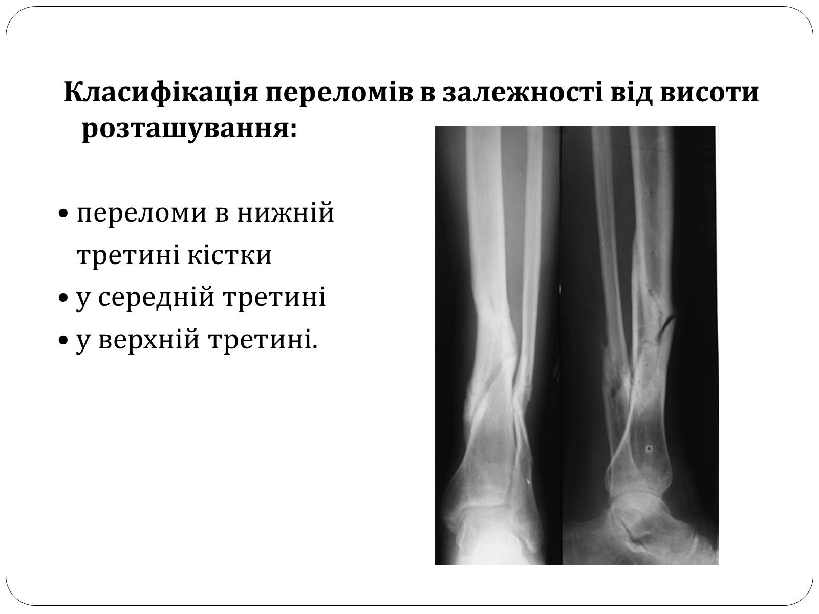 Презентація на тему «Вивихи, розтягнення, переломи. Перша допомога» - Слайд #17 Презентація на тему «Вивихи, розтягнення, переломи. Перша допомога» - Слайд #17