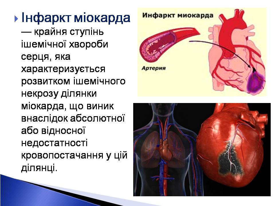 Презентація на тему «Інфаркт міокарда» (варіант 2) - Слайд #2 Презентація на тему «Інфаркт міокарда» (варіант 2) - Слайд #2
