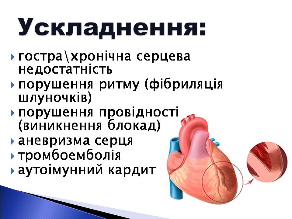 Презентація на тему «Інфаркт міокарда» (варіант 2) - Слайд #5 Презентація на тему «Інфаркт міокарда» (варіант 2) - Слайд #5