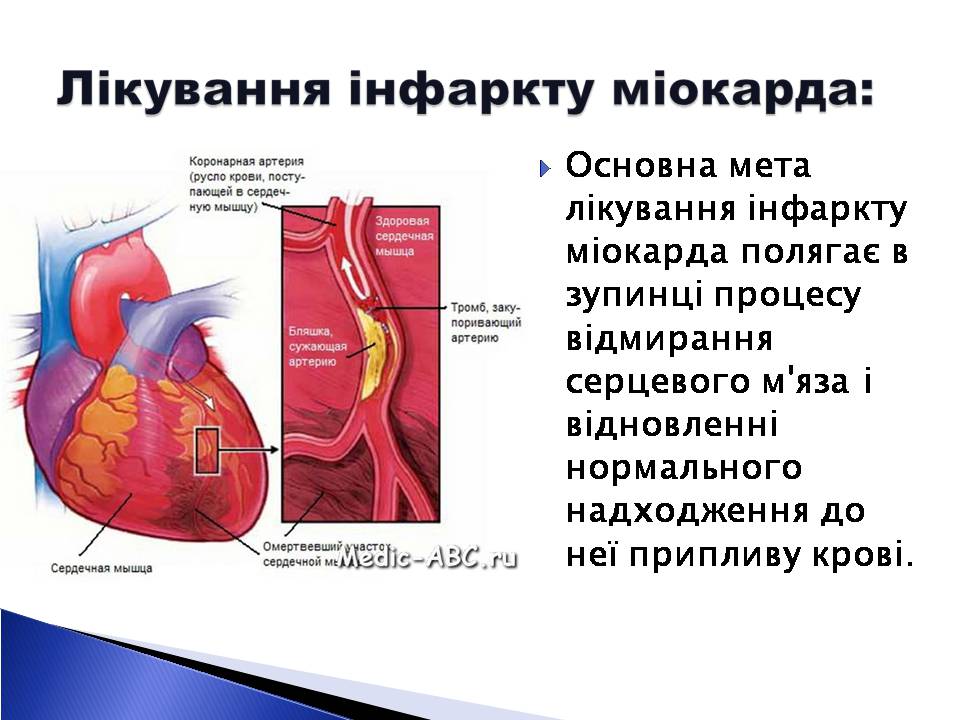 Презентація на тему «Інфаркт міокарда» (варіант 2) - Слайд #9 Презентація на тему «Інфаркт міокарда» (варіант 2) - Слайд #9