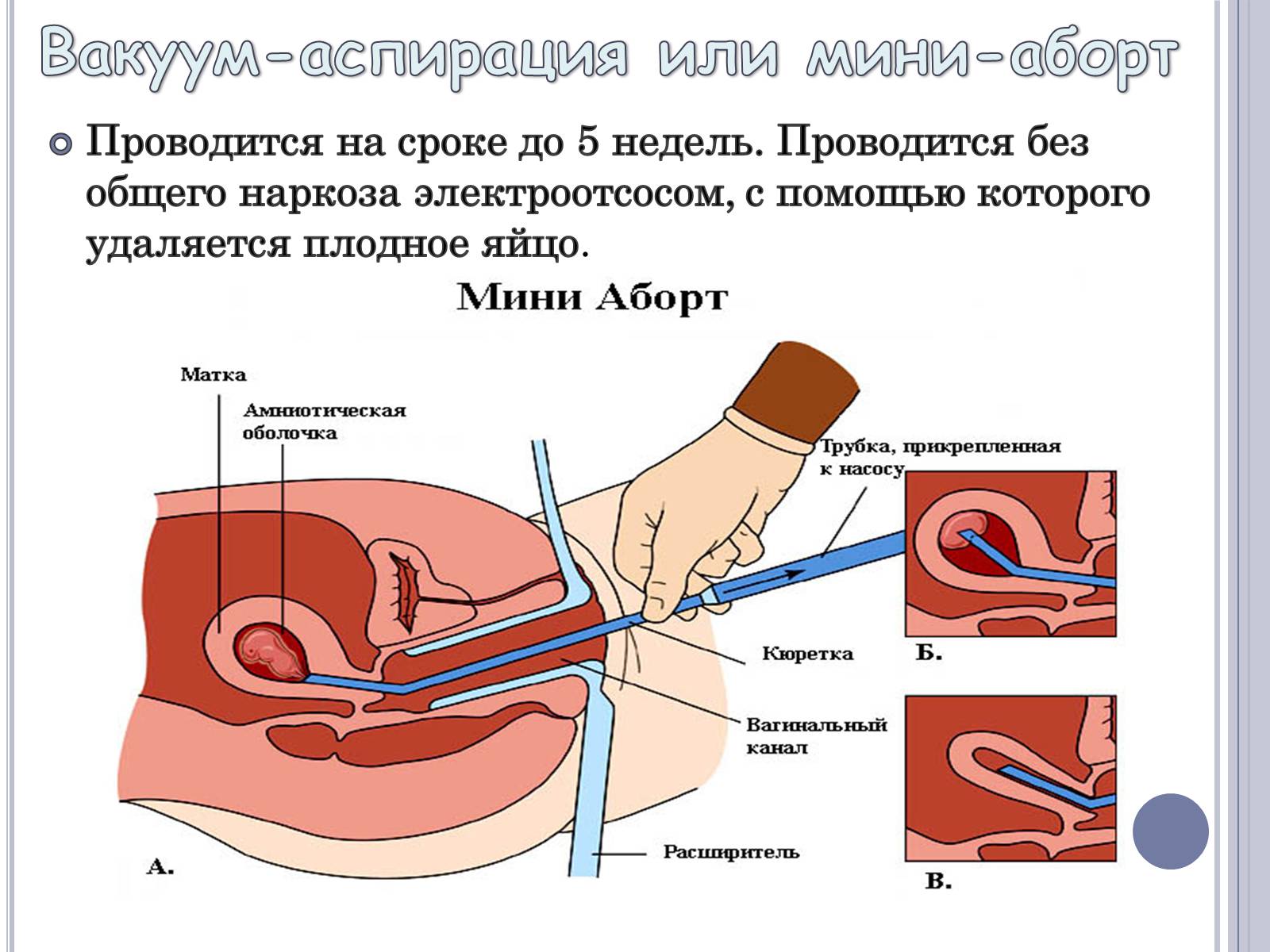 Презентація на тему «Аборт» - Слайд #6 Презентація на тему «Аборт» - Слайд #6