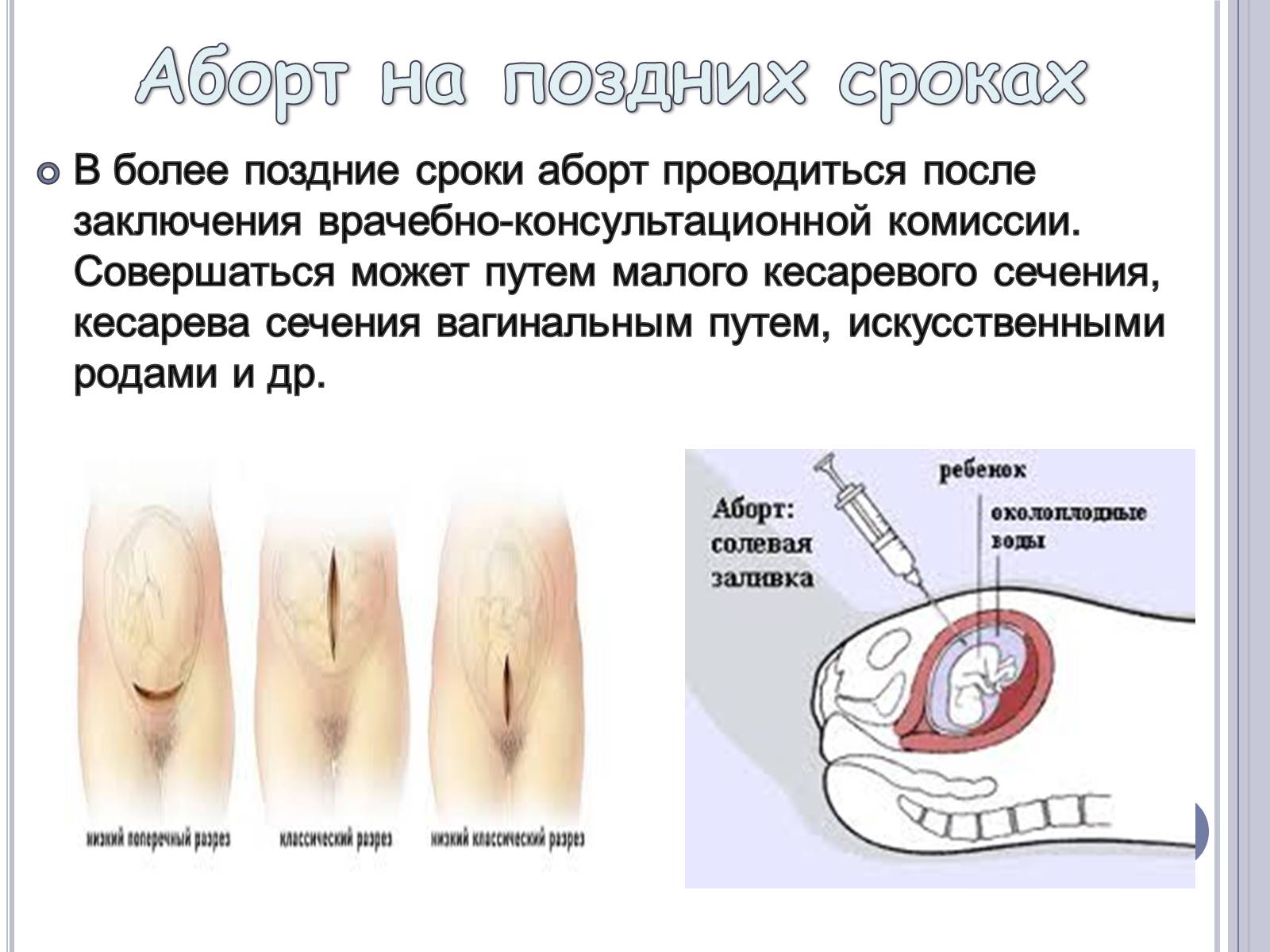 Презентація на тему «Аборт» - Слайд #9 Презентація на тему «Аборт» - Слайд #9