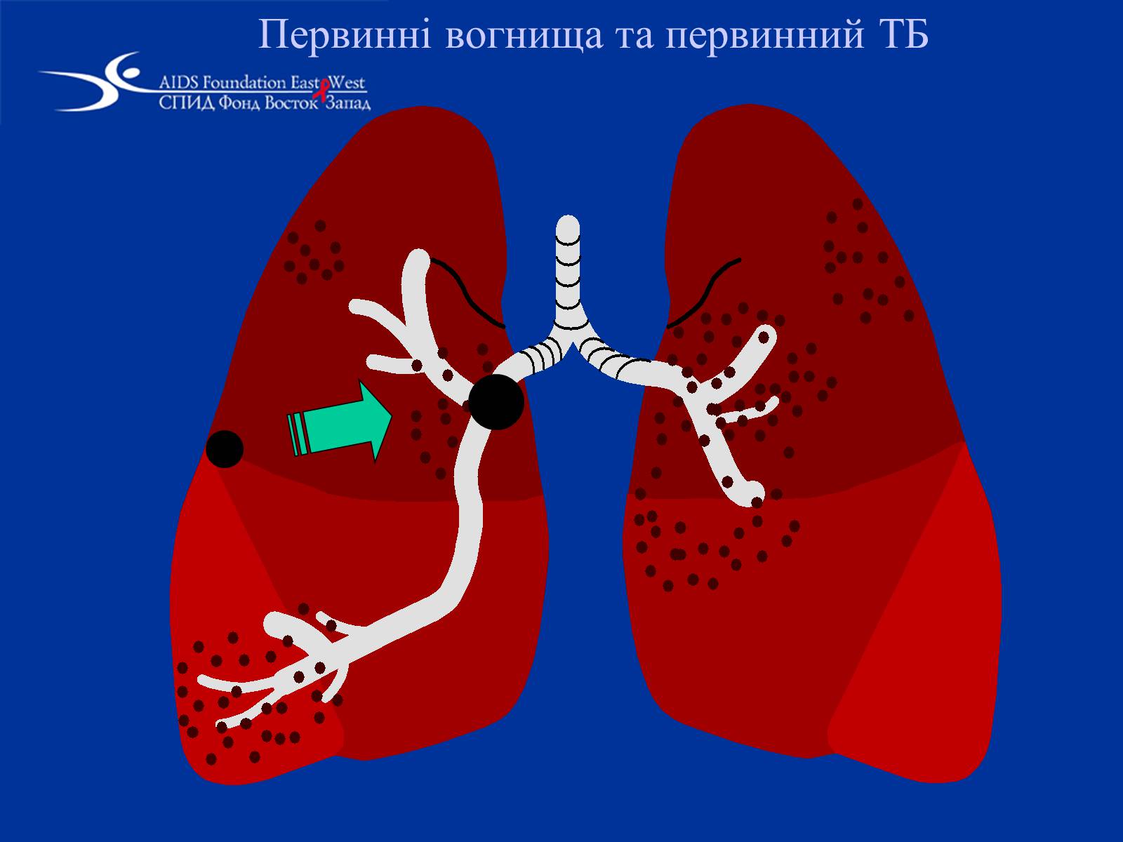 Презентація на тему «Туберкульоз» (варіант 1) - Слайд #22 Презентація на тему «Туберкульоз» (варіант 1) - Слайд #22