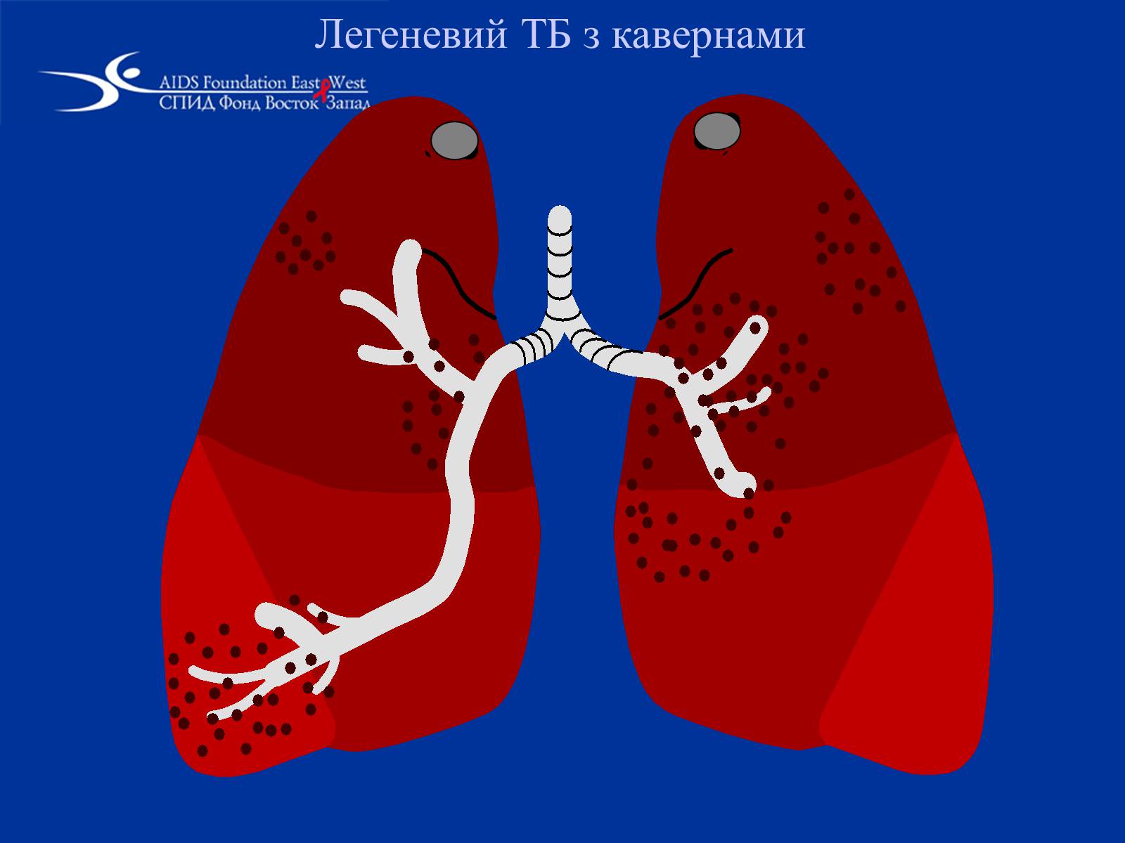 Презентація на тему «Туберкульоз» (варіант 1) - Слайд #25 Презентація на тему «Туберкульоз» (варіант 1) - Слайд #25