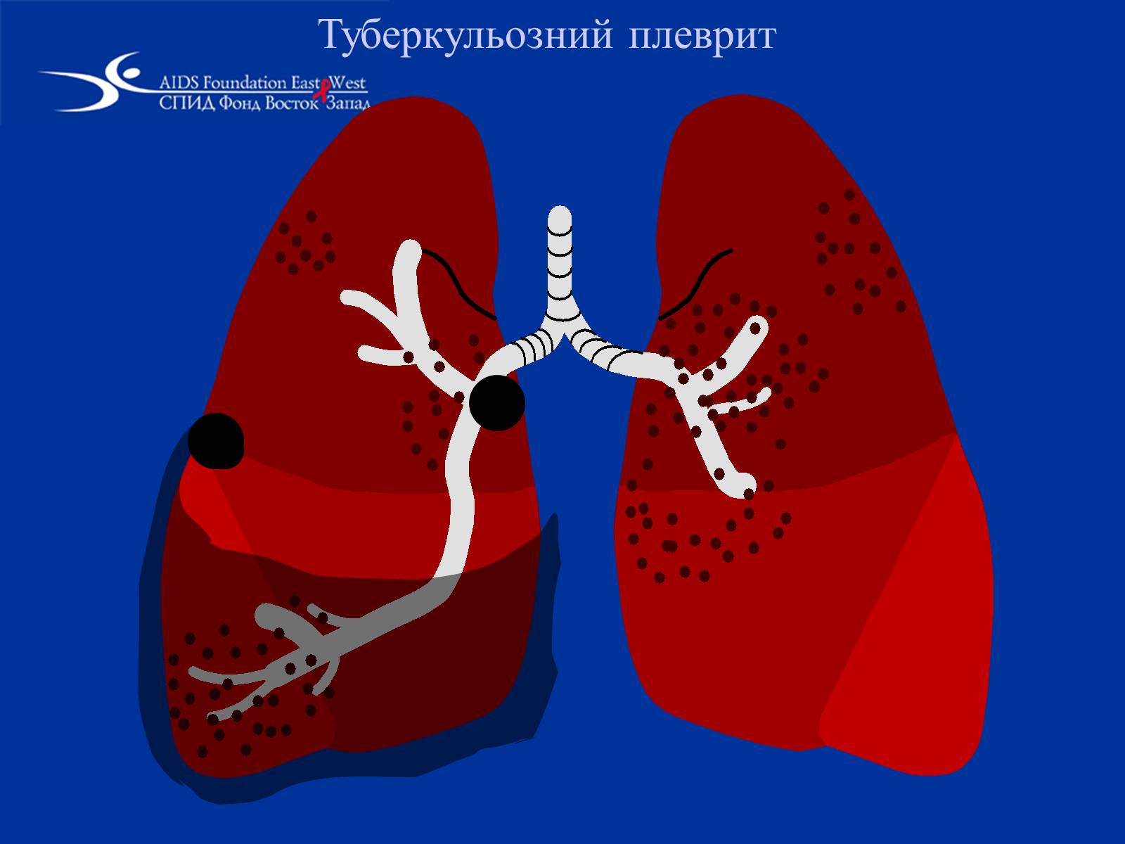 Презентація на тему «Туберкульоз» (варіант 1) - Слайд #26 Презентація на тему «Туберкульоз» (варіант 1) - Слайд #26
