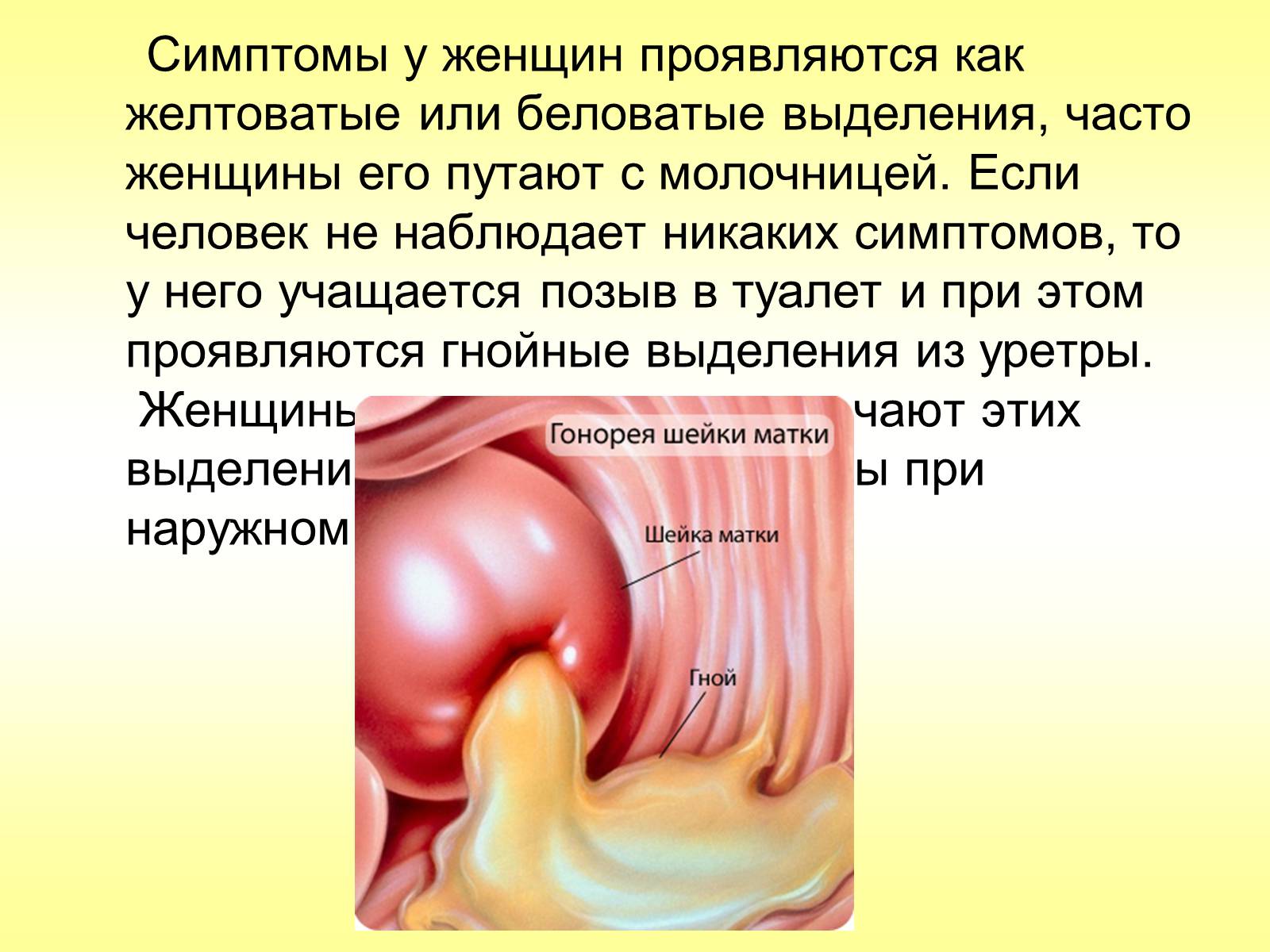 Презентація на тему «Гонорея» - Слайд #8 Презентація на тему «Гонорея» - Слайд #8
