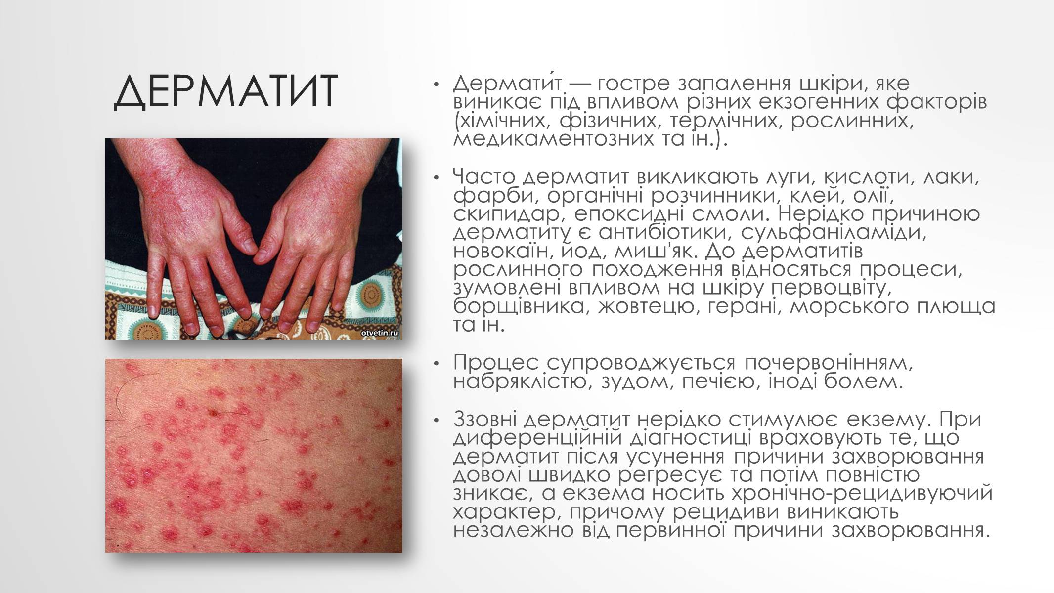 Презентація на тему «Шкірні захворювання» - Слайд #6 Презентація на тему «Шкірні захворювання» - Слайд #6