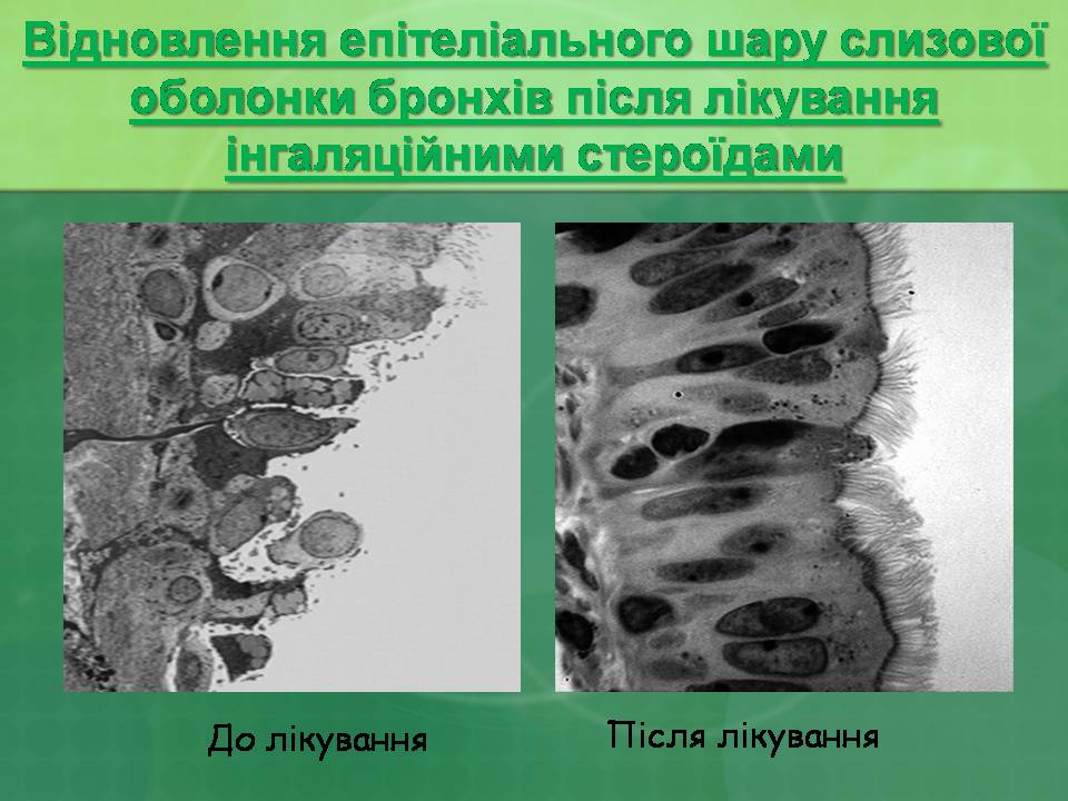 Презентація на тему «Бронхіальна астма» - Слайд #27 Презентація на тему «Бронхіальна астма» - Слайд #27