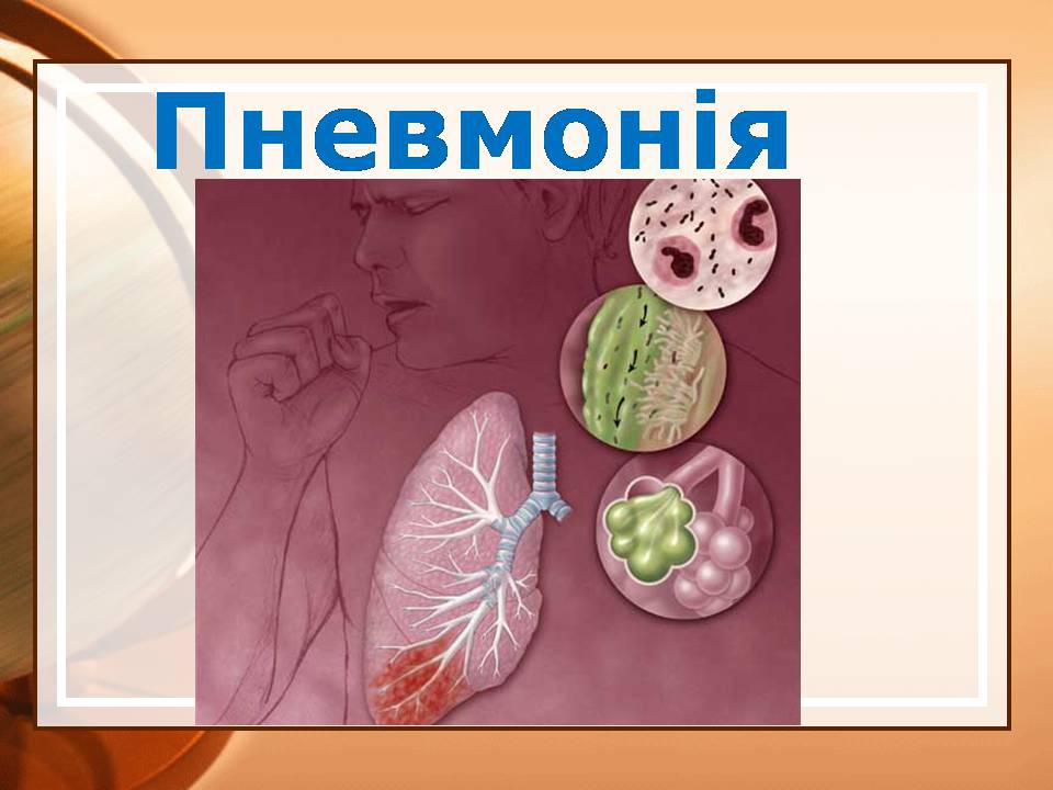 Презентація на тему «Пневмонія» - Слайд #1 Презентація на тему «Пневмонія» - Слайд #1