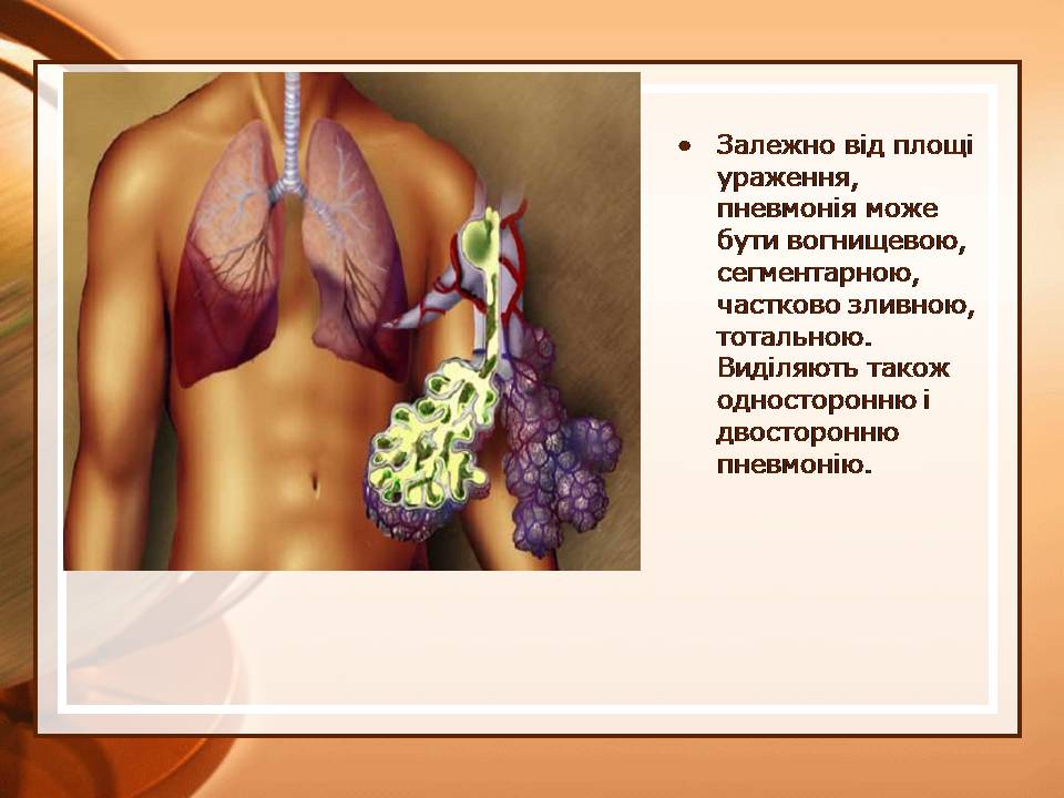 Презентація на тему «Пневмонія» - Слайд #7 Презентація на тему «Пневмонія» - Слайд #7