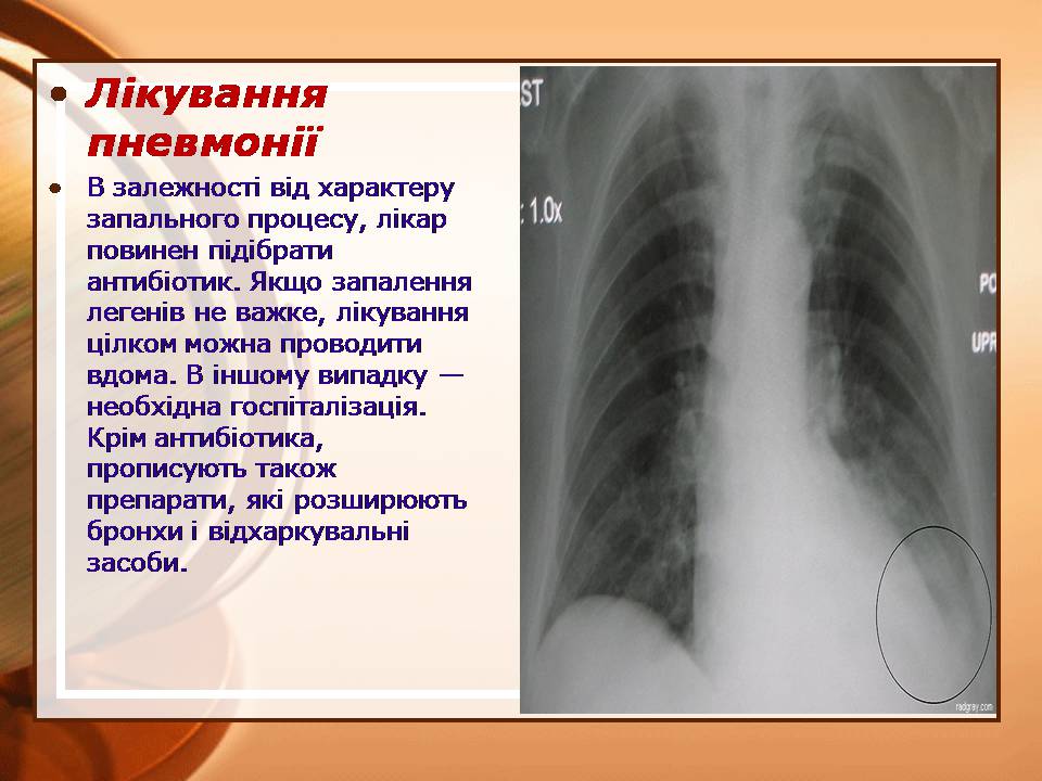 Презентація на тему «Пневмонія» - Слайд #9 Презентація на тему «Пневмонія» - Слайд #9