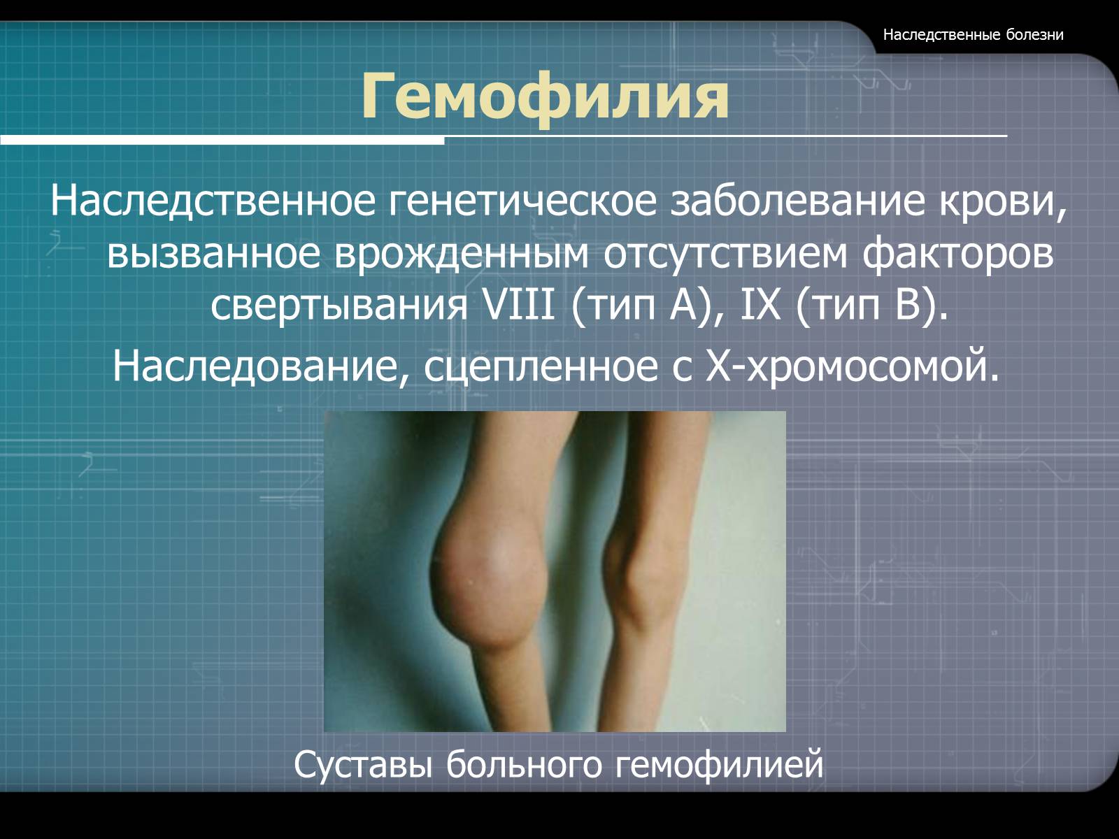 Презентація на тему «Наследственные болезни» - Слайд #10
