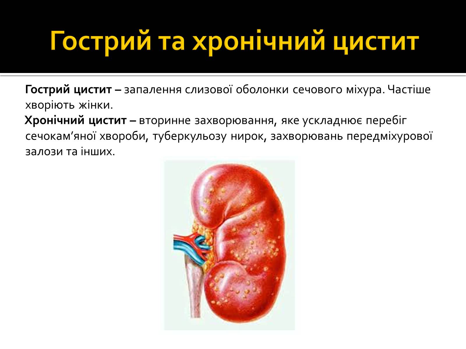 Презентація на тему «Захворювання нирок та сечовивідних шляхів» - Слайд #10 Презентація на тему «Захворювання нирок та сечовивідних шляхів» - Слайд #10
