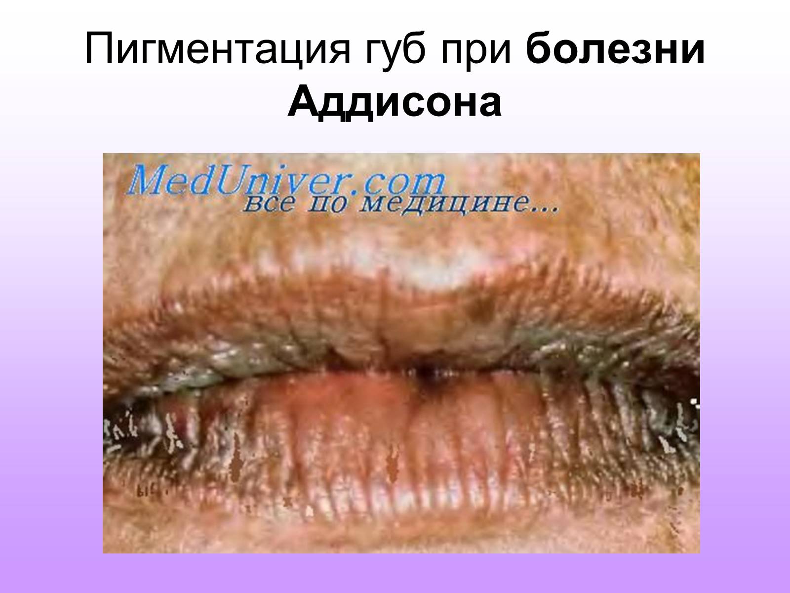 Презентація на тему «Надпочечники» - Слайд #23 Презентація на тему «Надпочечники» - Слайд #23