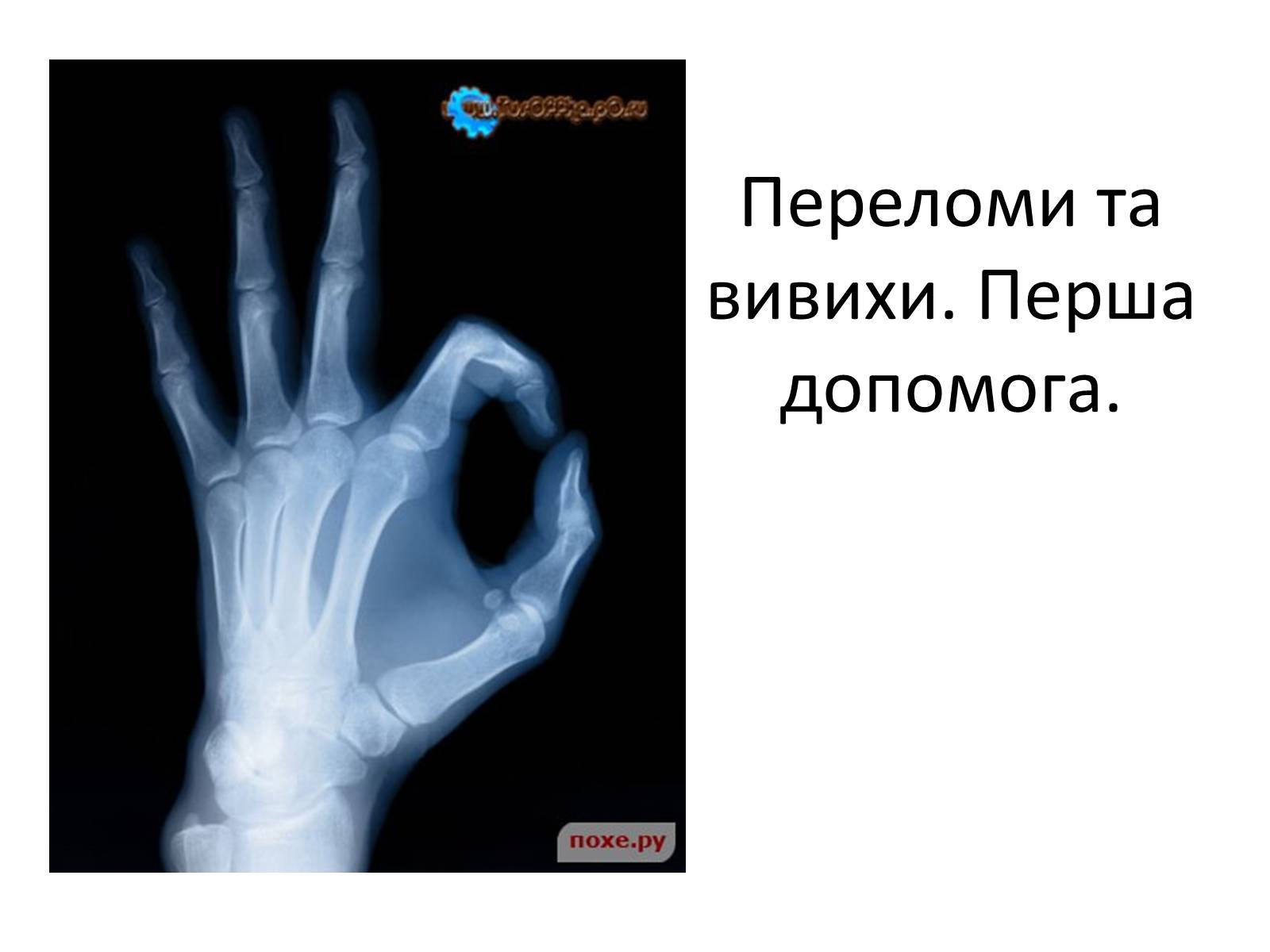 Презентація на тему «Переломи та вивихи. Перша допомога» - Слайд #1 Презентація на тему «Переломи та вивихи. Перша допомога» - Слайд #1