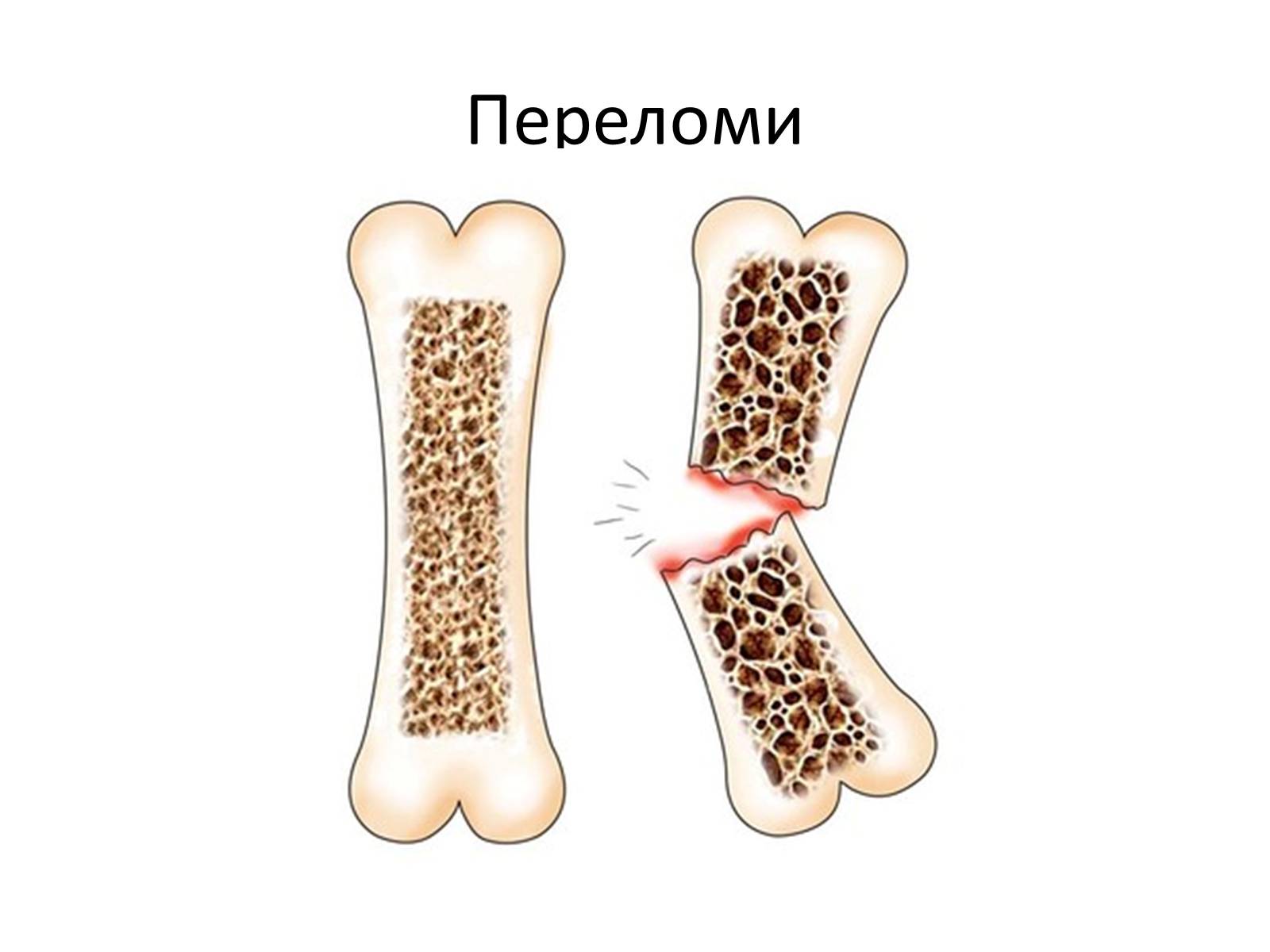 Презентація на тему «Переломи та вивихи. Перша допомога» - Слайд #10 Презентація на тему «Переломи та вивихи. Перша допомога» - Слайд #10