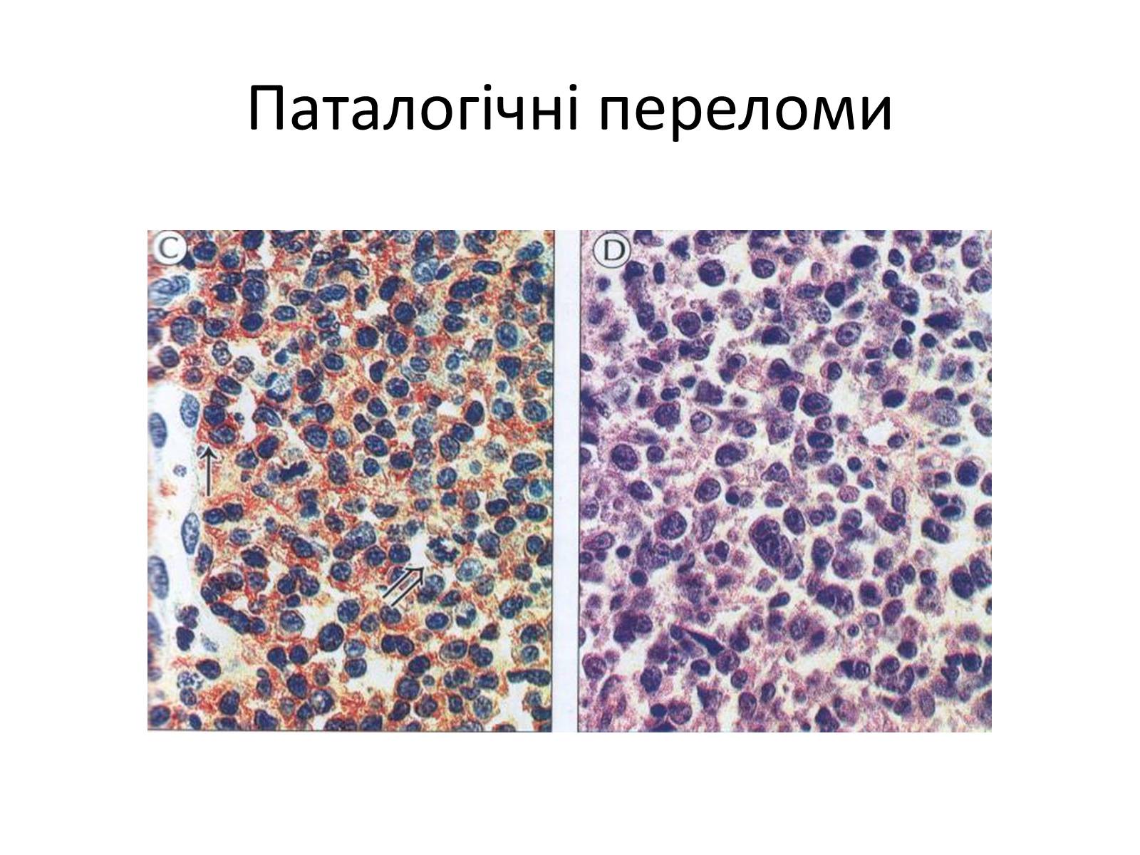 Презентація на тему «Переломи та вивихи. Перша допомога» - Слайд #14 Презентація на тему «Переломи та вивихи. Перша допомога» - Слайд #14