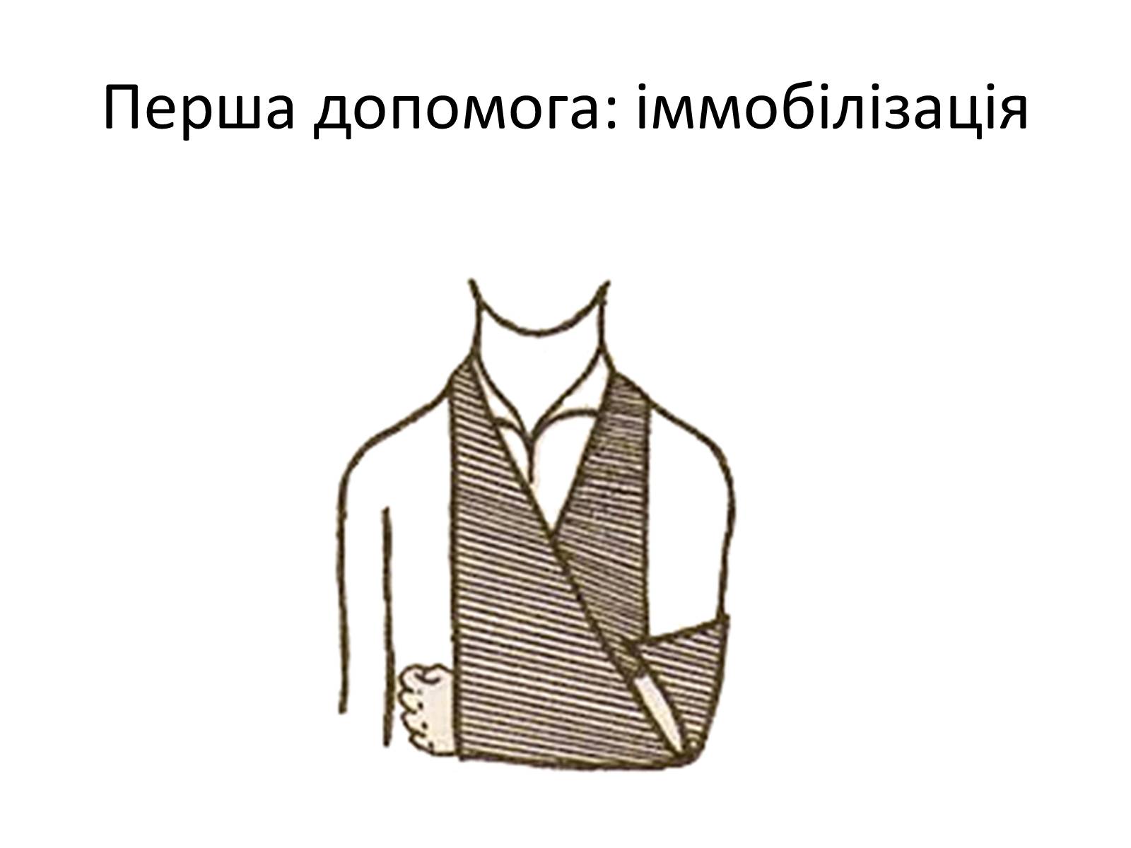 Презентація на тему «Переломи та вивихи. Перша допомога» - Слайд #15 Презентація на тему «Переломи та вивихи. Перша допомога» - Слайд #15