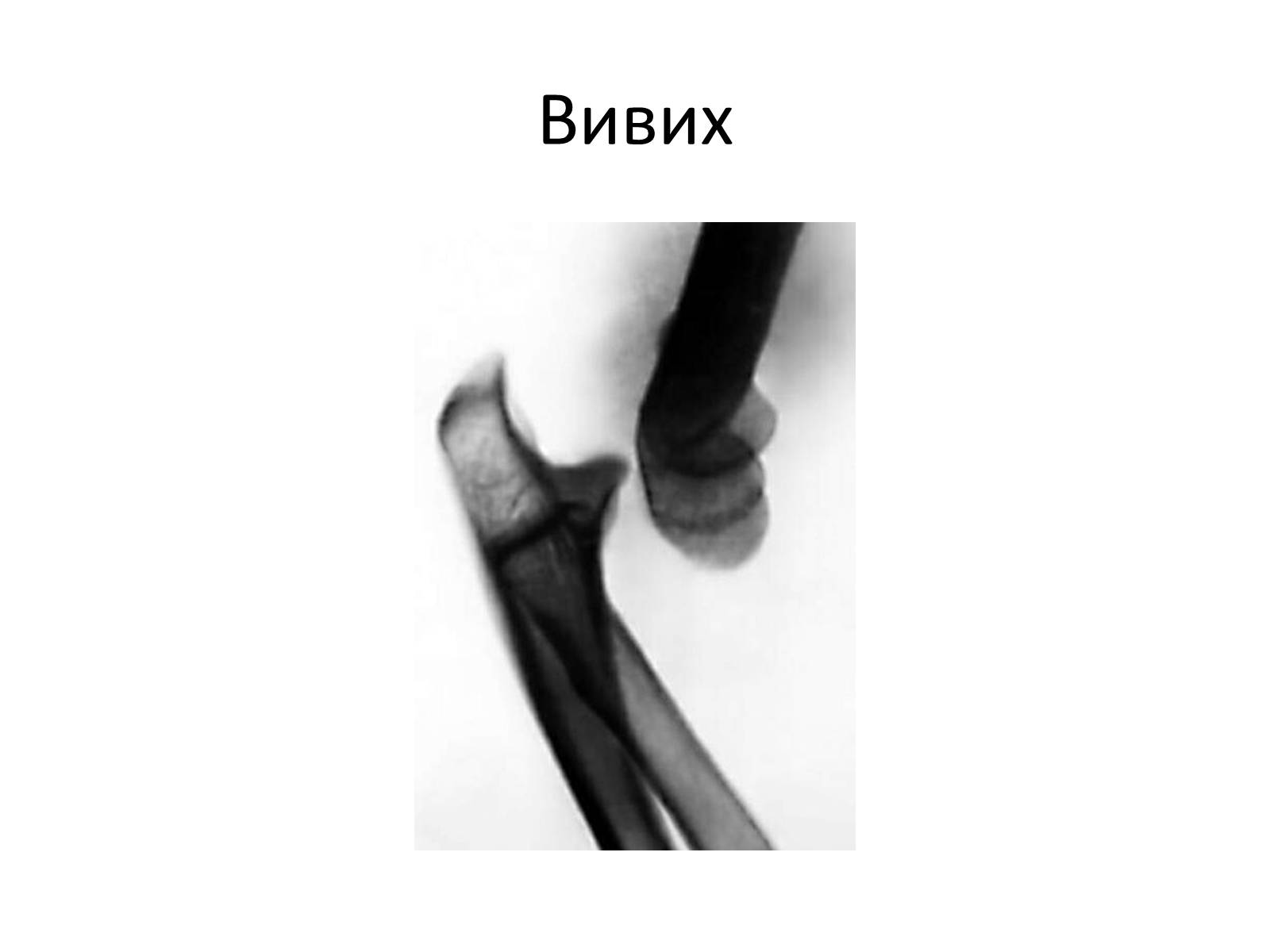 Презентація на тему «Переломи та вивихи. Перша допомога» - Слайд #2 Презентація на тему «Переломи та вивихи. Перша допомога» - Слайд #2